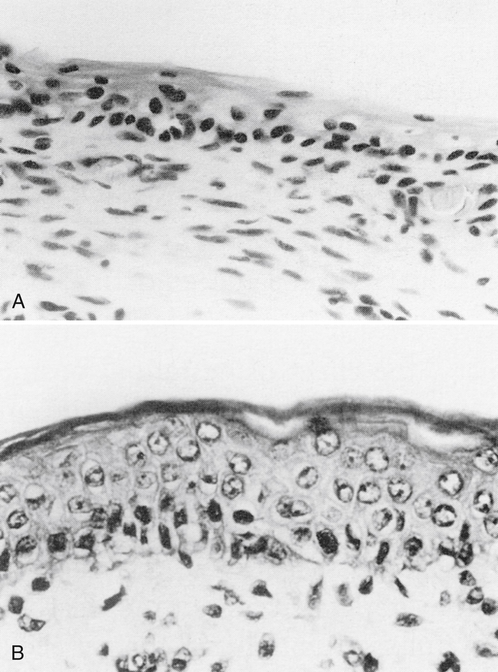 Fig. 44.9, Rapid development of the epidermal barrier after exposure to the ambient environment (xeric stress) in very low birth-weight preterm infants. (A) The epidermis of a 26-week gestational age infant on day 1 of life. No stratum corneum is present and the nucleated epidermis is thin. (B) The epidermis of a 26-week gestational age infant on postnatal day 10.