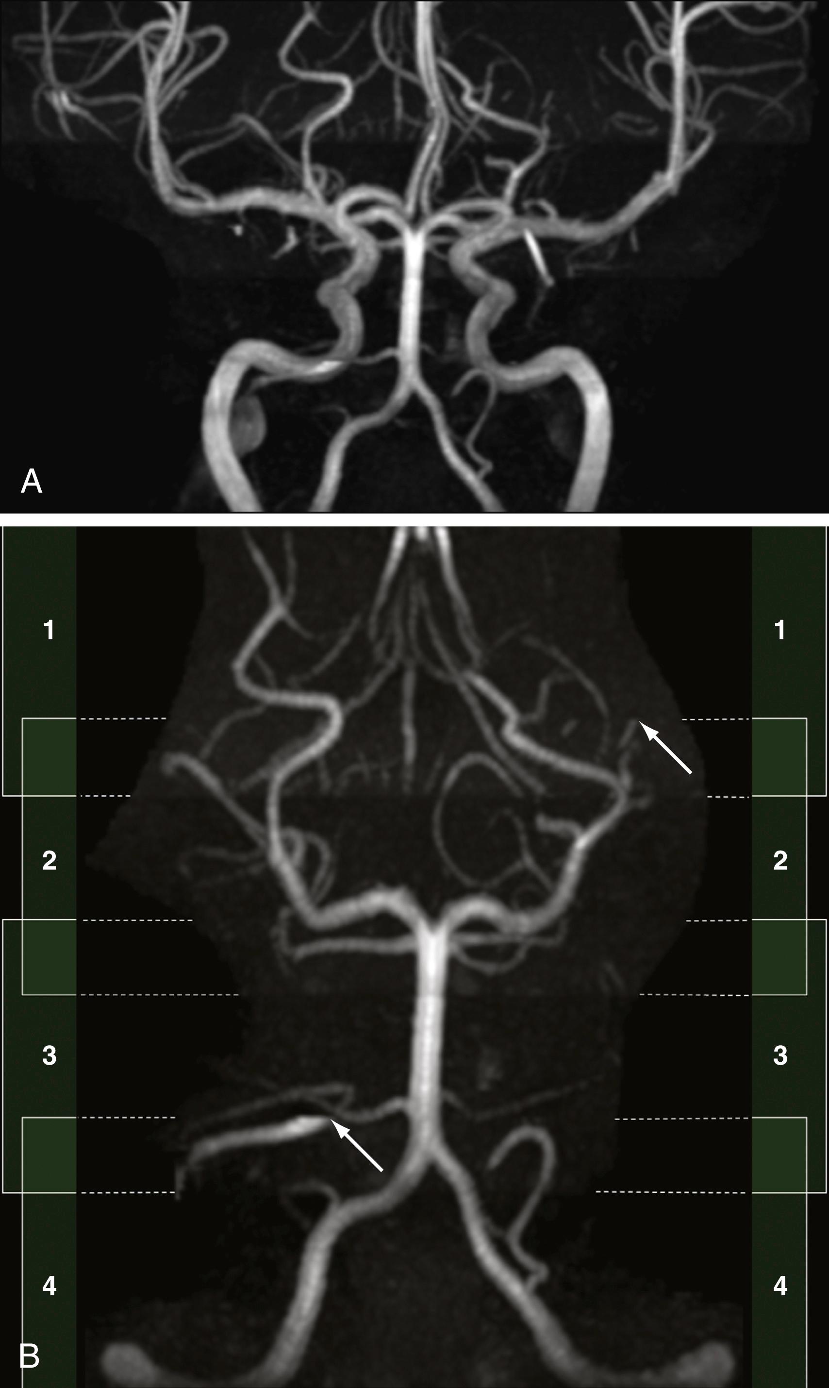 Figure 12.11, Coronal maximum-intensity projections of a three-dimensional time-of-flight MR angiogram (A) and segmented projection of the vertebrobasilar system only (B). The sequences are ordinarily acquired by using multiple overlapping slabs to increase the conspicuity of vessels. Where slabs overlap (indicated schematically by bright green reflecting slabs 1 plus 2, or 2 plus 3, or 3 plus 4), one sees better signal but also an abrupt increase in venous signal ( arrows in B). The viewer should be aware of this slab-related artifact when interpreting maximum-intensity projection images as this may create the appearance of focal areas of increased conspicuity of normal venous structures, which should not be confused with pathologic vascular malformations.