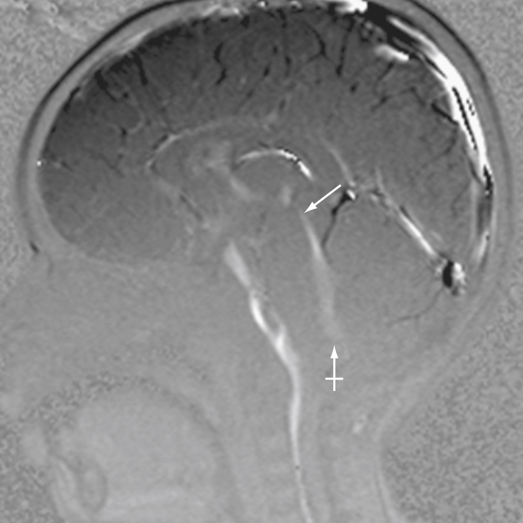 Figure 12.12, Normal cerebrospinal fluid (CSF) flow pattern.