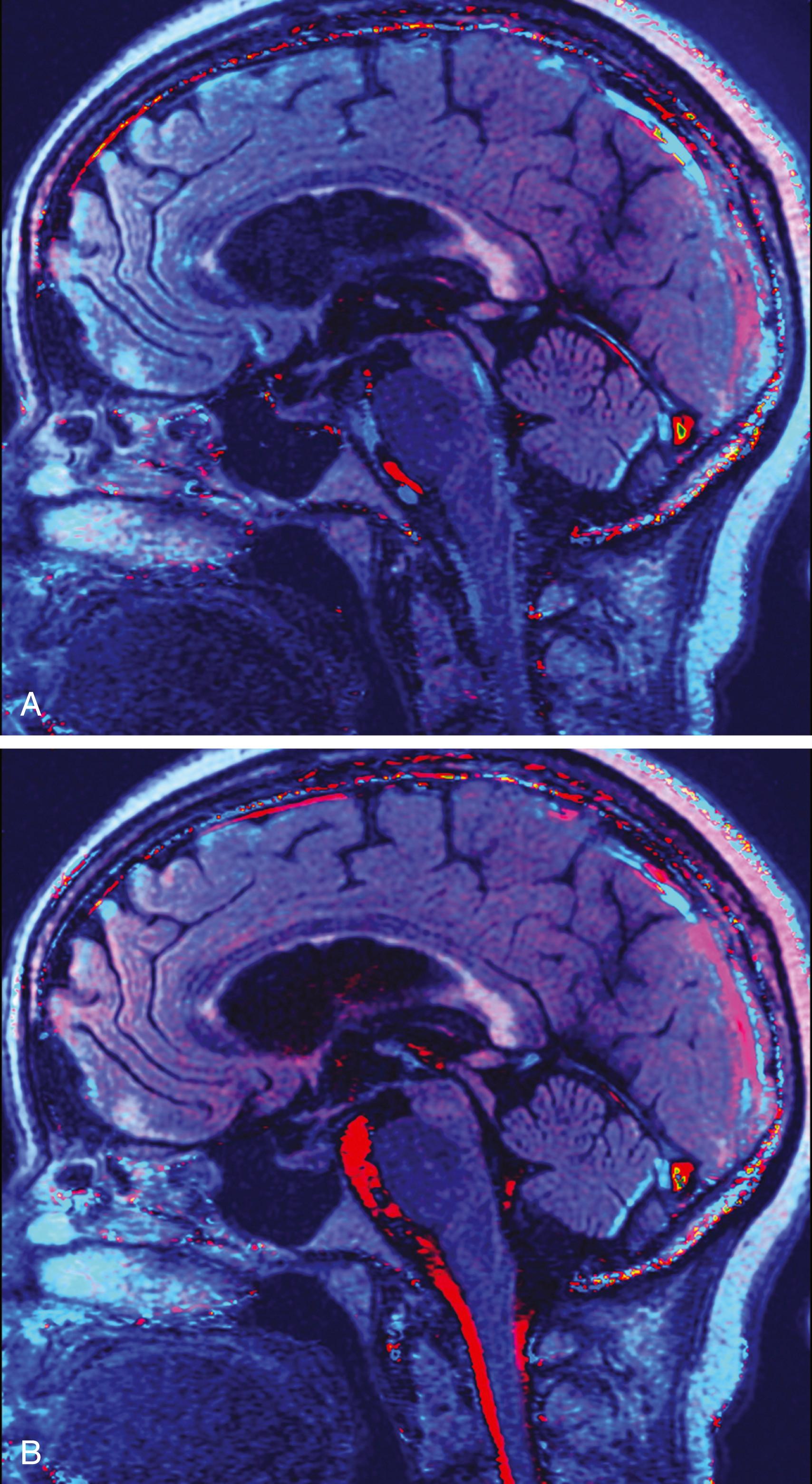 Figure 12.13, Color-encoded superior-inferior sensitized images from a phase-contrast cerebrospinal fluid (CSF) flow study.