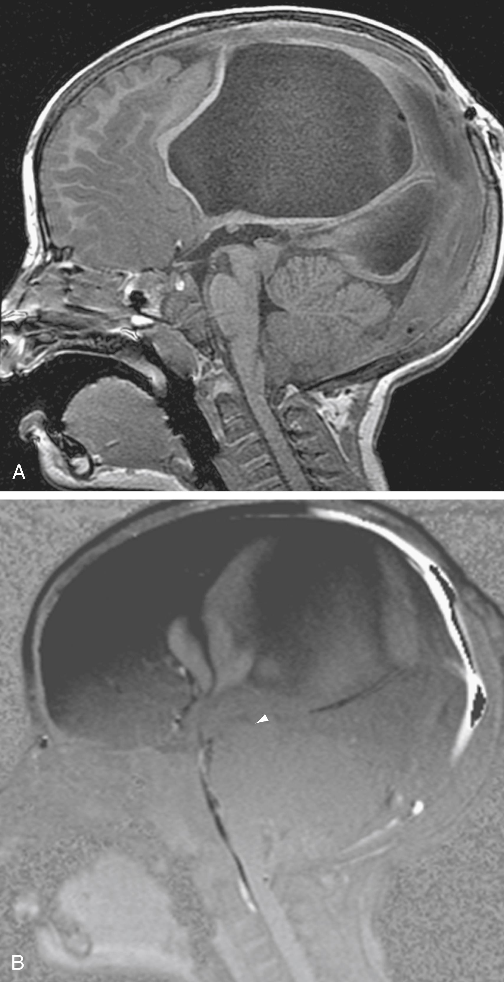 Figure 12.14, A 4-year-old female patient with septo-optic dysplasia and colpocephaly who had previously been shunted.