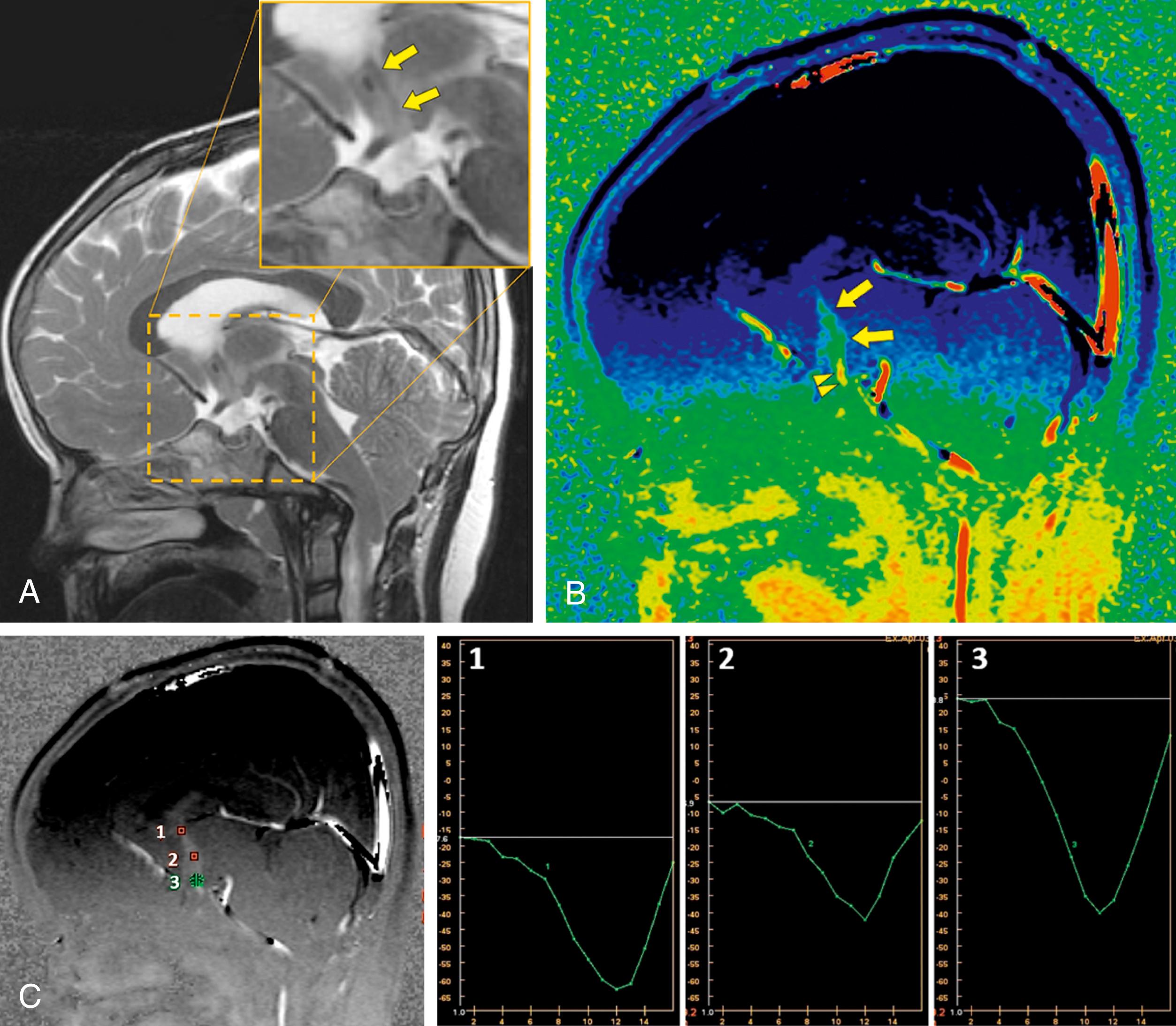 Figure 12.15, Representation of successful third ventriculostomy in a child with a Chiari I malformation. (A) Sagittal T2-weighted thin-slice acquisition image shows a subtle jet (arrows in magnified inset) likely reflecting CSF dephasing of the signal just superior to the patent third ventriculostomy. (B) Color-encoded superior-inferior sensitized image from a gated phase-contrast CSF flow study demonstrates broad CSF pulsation through the anterior third ventricle (arrows) and more focal flow of greater magnitude through the actual ventriculostomy (arrowheads) . (C) Quantification of flow depicted over a single cycle (with each x axis in 1–3 indicating a cardiac cycle, and y axis reflecting magnitude in each ROI) shows differing CSF jet signal depending on location, with the greatest magnitude in ROI 3 where flow is most concentrated across the ventriculostomy.