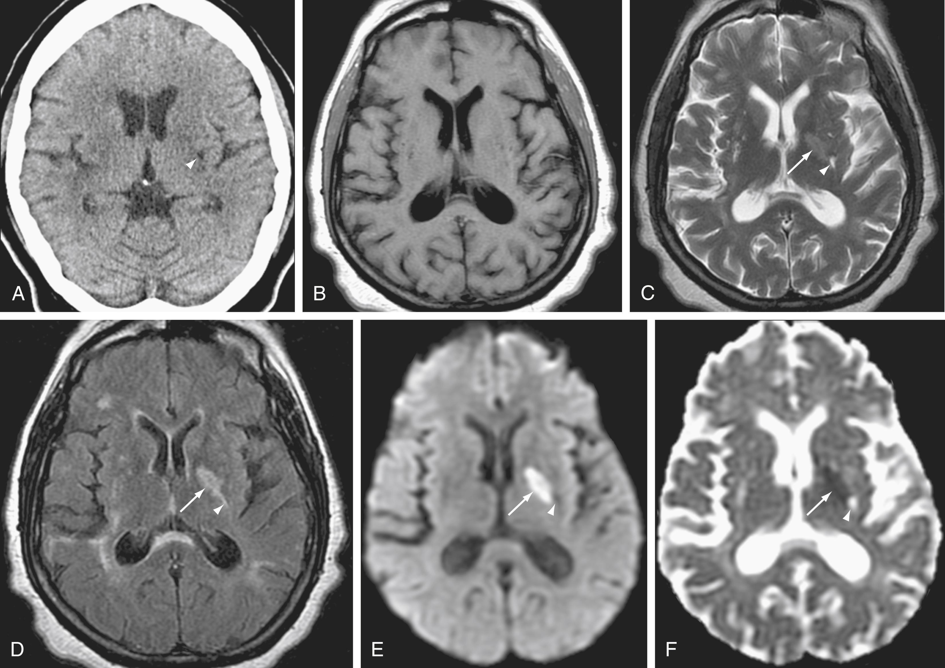 Figure 12.2, Acute left basal ganglia infarct.