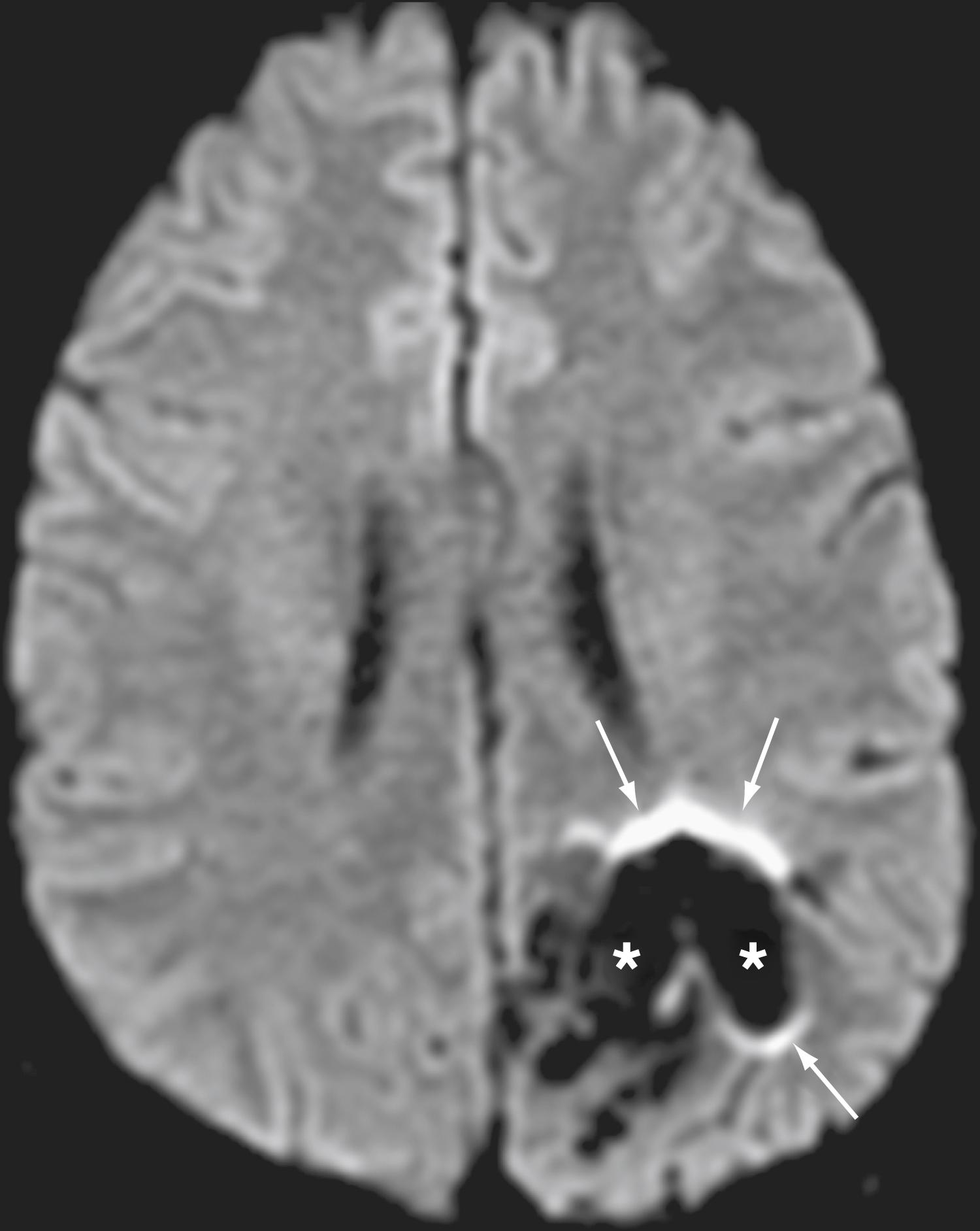 Figure 12.3, Axial diffusion-weighted image shows diminished signal around an arteriovenous malformation, which had been embolized previously. There is significant signal loss within the embolized bed (asterisks) and a halo of high signal distortion around the margin of the embolized nidus (arrows) . Serpiginous low signal at the posteromedial aspect of the lesion could represent flow voids resulting from residual patent vessels or susceptibility artifact.