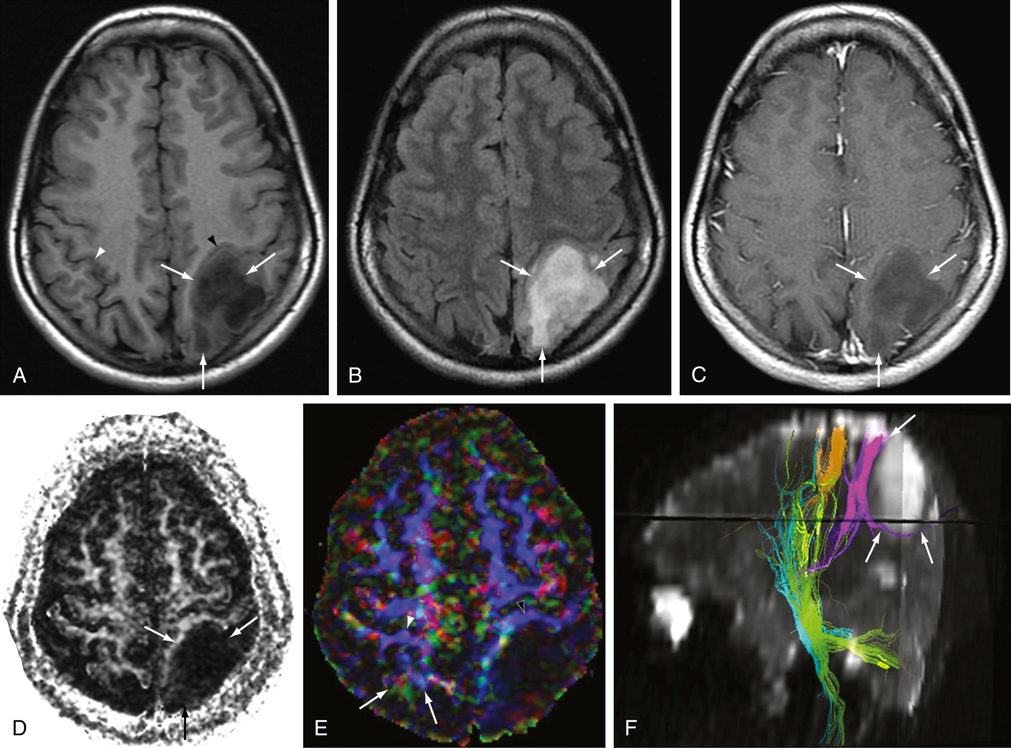 Figure 12.5, Infiltrating parietal glioma.