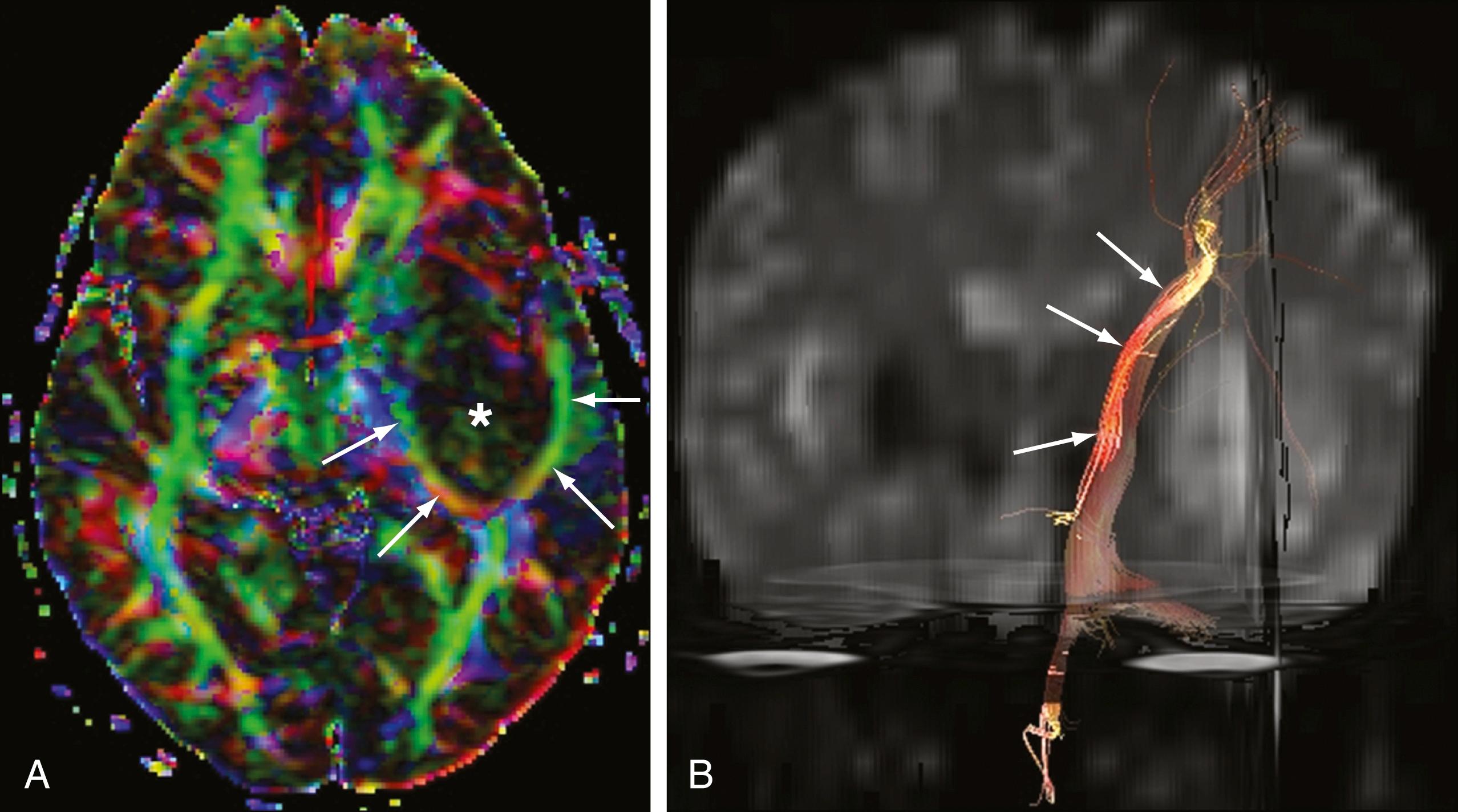 Figure 12.6, Diffusion tensor characterization of white matter integrity around a glioma centered near the left sylvian point.