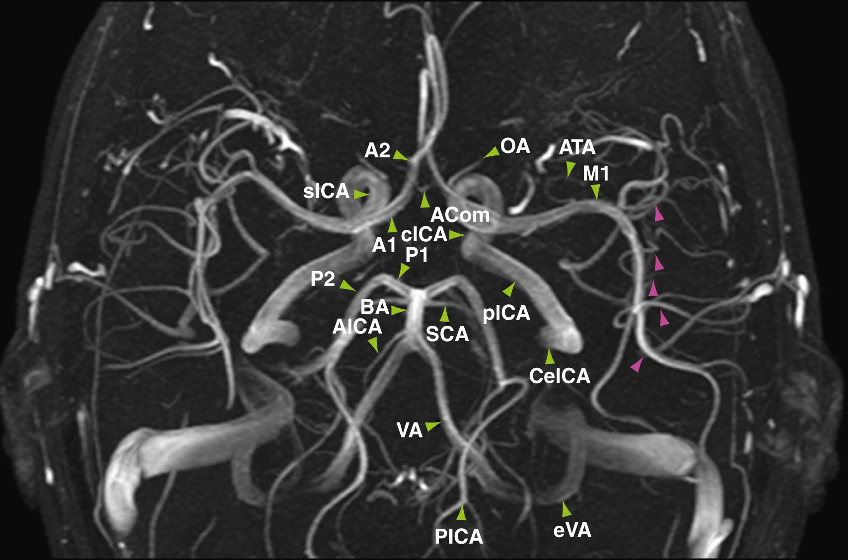 Figure 12.7, Collapsed maximum-intensity projection of a three-dimensional time-of-flight MR angiogram.