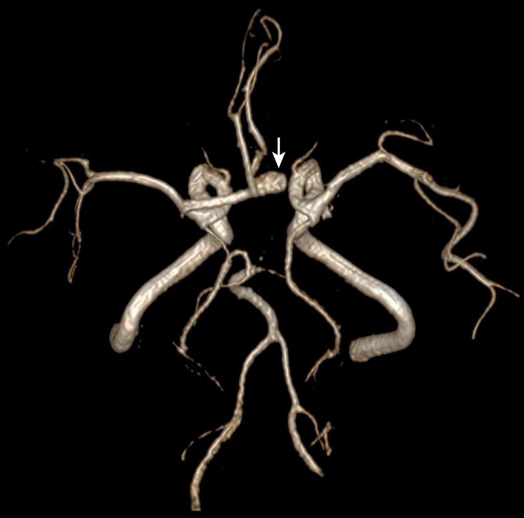 Figure 12.8, Surface rendering of a three-dimensional time-of-flight MR angiogram reveals an aneurysm of the anterior communicating artery (arrow) .