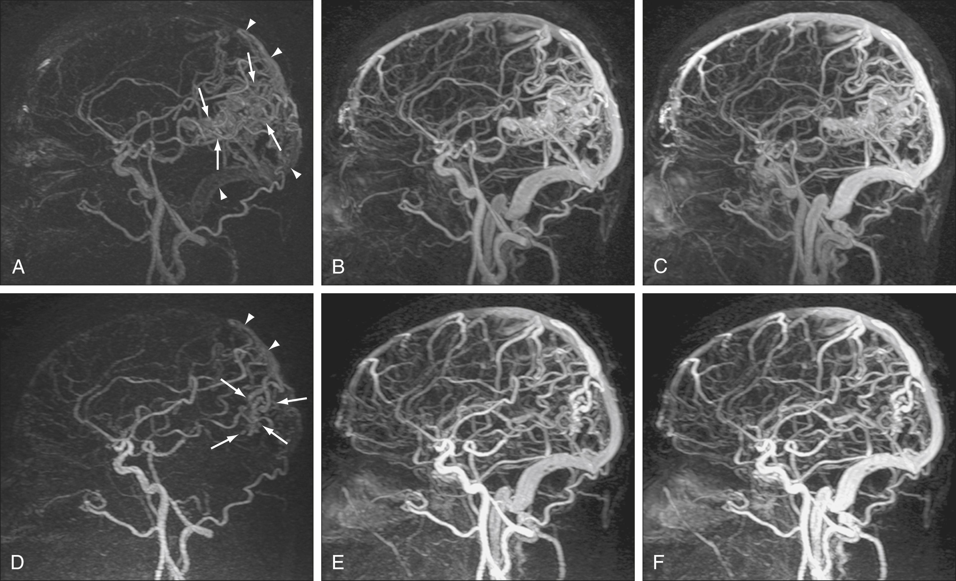 Figure 12.9, Time-resolved contrast-enhanced MR angiography shows embolization of an arteriovenous malformation.