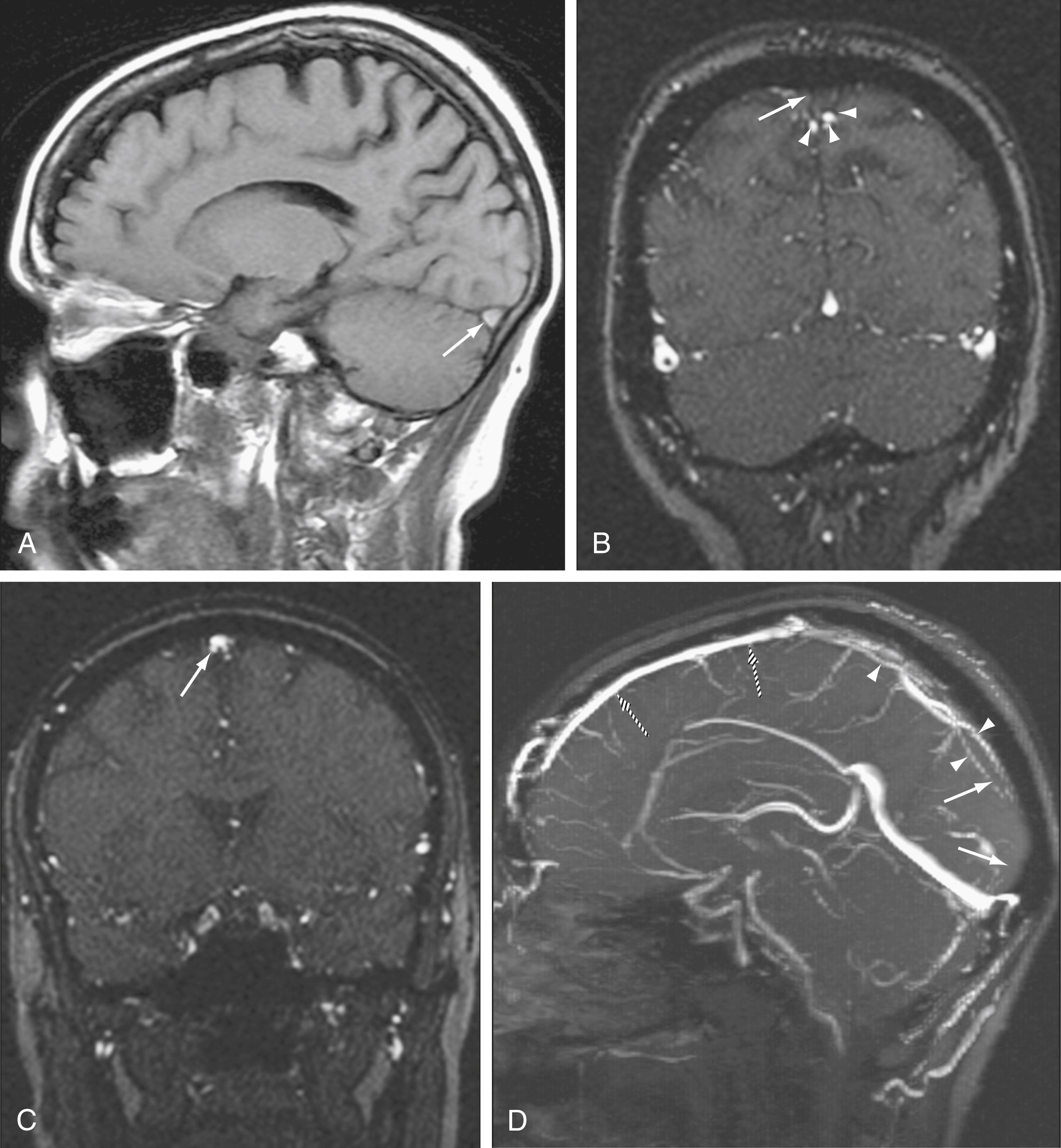 Figure 12.10, Dural venous thrombosis.