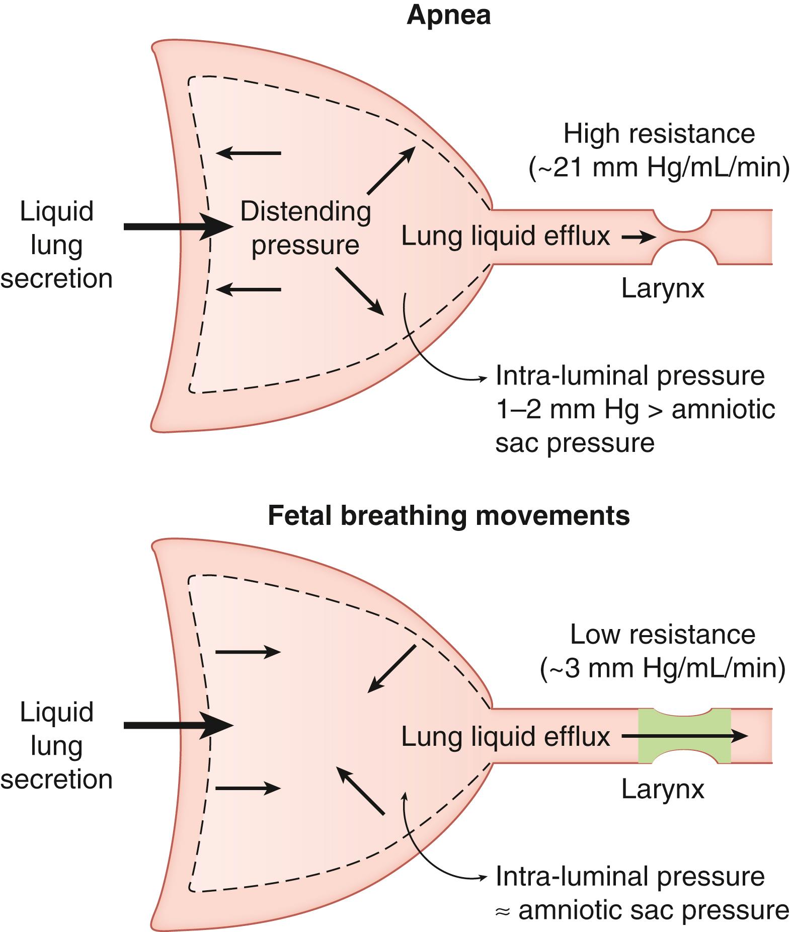 Fig. 57.3, The role of the fetal upper airway in regulating the efflux of fetal lung liquid (FLL) during periods of apnea (upper panel) and of fetal breathing movements (FBMs) (lower panel) . During periods of apnea, the resistance to FLL efflux through the upper airway is high (owing to a lack of laryngeal abductor activity and the presence of tonic adductor activity); as a result, FLL tends to accumulate within the future airways, causing the lungs to expand. This liquid accumulation is responsible for generating a transpulmonary pressure gradient of 1 to 2 mm Hg (intra-airway pressure greater than amniotic sac pressure). During periods of FBM, the resistance to FLL efflux through the upper airway decreases (owing to phasic dilator activity of glottic abductor muscles and lack of sustained activity in adductor muscles); therefore, FLL leaves the lungs at an increased rate.