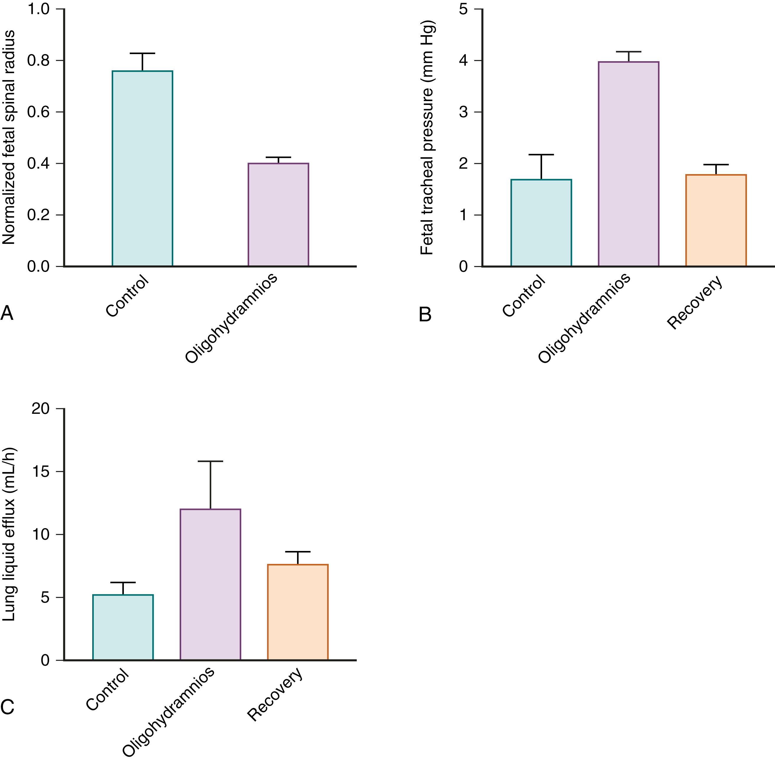 Fig. 57.4, The effect of oligohydramnios on spinal flexion, fetal tracheal pressure, and fetal lung liquid efflux. (A) Oligohydramnios induced by amniotic fluid drainage in fetal sheep increases spinal flexion (a smaller normalized spinal radius is indicative of greater curvature of the spine). Fetal tracheal pressure (B) and lung liquid efflux along the trachea (C) during a control period, a 48-hour period of oligohydramnios (induced by draining amniotic fluid) and after replacement of amniotic fluid (recovery) in fetal sheep.