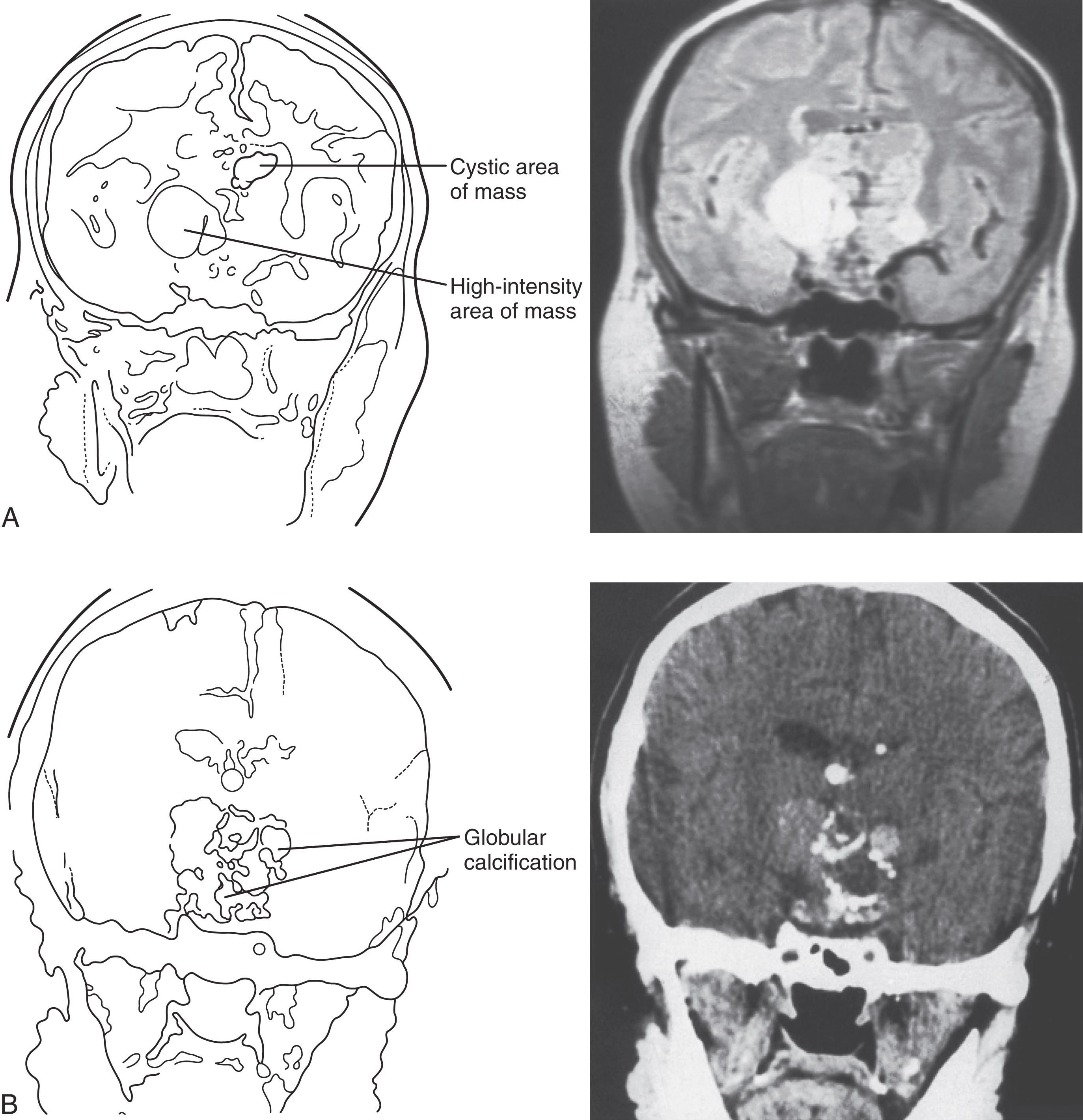 Fig. 21.3, (A) Schematic and proton-density-weighted coronal magnetic resonance imaging showing a cystic area and a high-intensity signal area in a large sellar-suprasellar mass typical of craniopharyngiomas. (B) Characteristic globular calcification is apparent on a coronal computerized tomography image of the same patient.