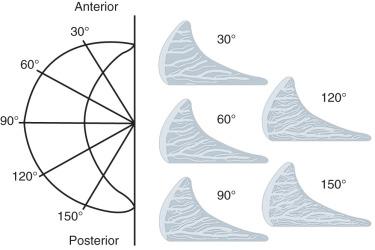 Fig. 1.3, Radial collagen fiber bundles of the meniscus. Radial tie fibers consisting of branching bundles of collagen fibrils extend from the periphery of the meniscus to the inner rim in every radial section throughout the meniscus. They are more abundant in the posterior sections and gradually diminish in number as the sections progress toward the anterior region of the meniscus.