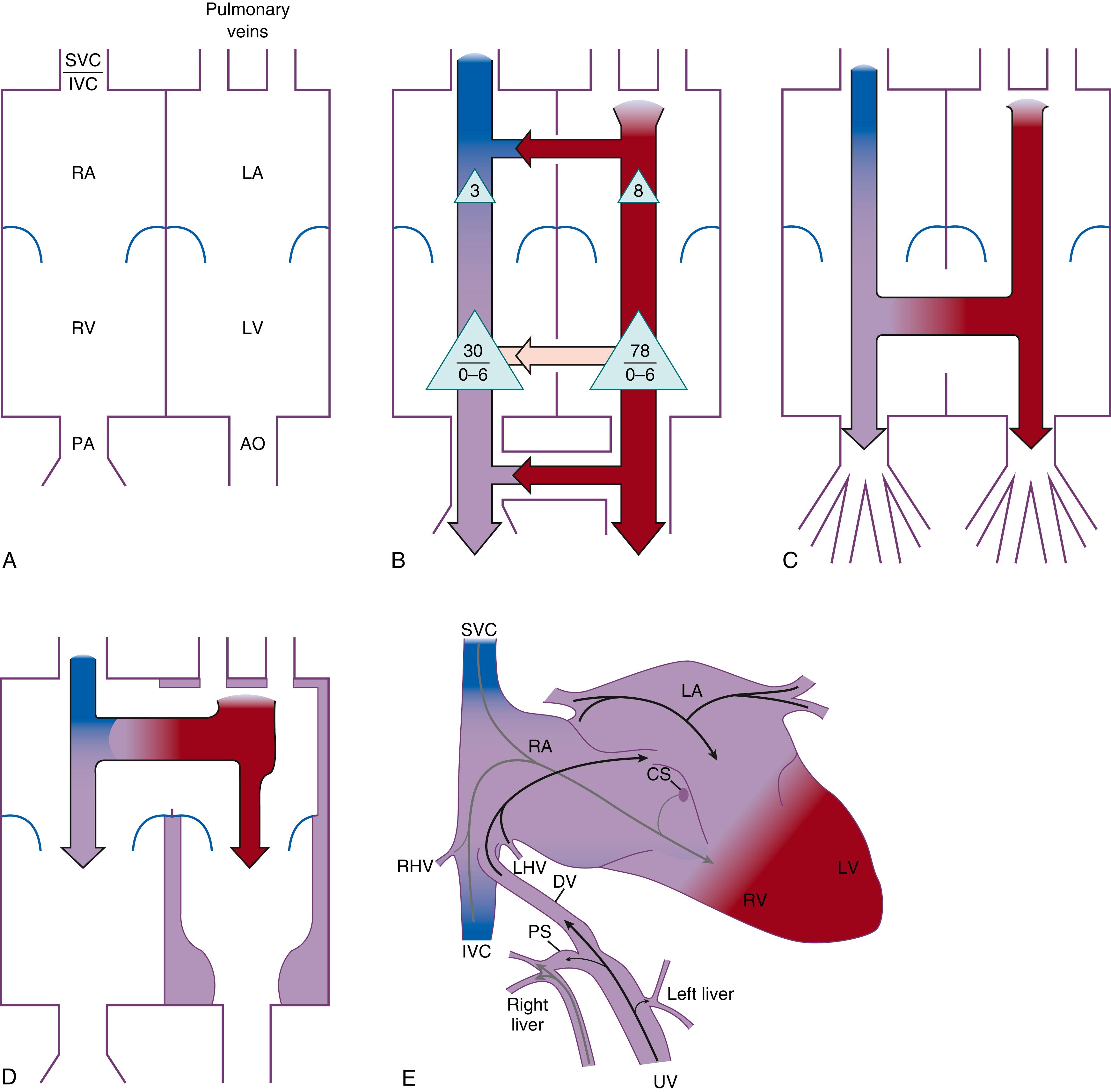 Fig. 49.1, Factors that influence where blood goes with structural heart lesions. (A) General scheme of box diagrams. (B) Blood moves from high pressure to low. Shunting at the atrial, ventricular, and great vessel levels can result from a pressure gradient between communicating structures if the communication is small enough to be pressure restrictive. (C) When two vascular beds differing in resistance to flow are connected to a source of flow, more blood finds its way into the lower-resistance circuit than into the higher-resistance circuit. With an unrestrictive ventricular septal defect and low pulmonary vascular resistance, systolic pressures are essentially the same in both the aorta and the pulmonary artery, yet there is more flow to the pulmonary artery. (D) When two chambers differing in resistance to filling (compliance) are connected by a large defect, more blood finds its way into the chamber with the greater compliance. (E) Streaming can influence the chamber or vessel to which the blood flows. As depicted here, in the fetus umbilical venous blood preferentially crosses the foramen ovale, and therefore the most highly oxygenated blood tends to go to the organs of greatest need. Streaming can also take place at the ventricular and great vessel levels. AO, Aorta; CS, coronary sinus; DV, ductus venosus; IVC, inferior vena cava; LA, left atrium; LHV, left hepatic vein; LV, left ventricle; PA, pulmonary artery; PS, portal sinus; RA, right atrium; RHV, right hepatic vein; RV, right ventricle; SVC, superior vena cava; UV, umbilical vein. Numbers in triangles indicate pressure.