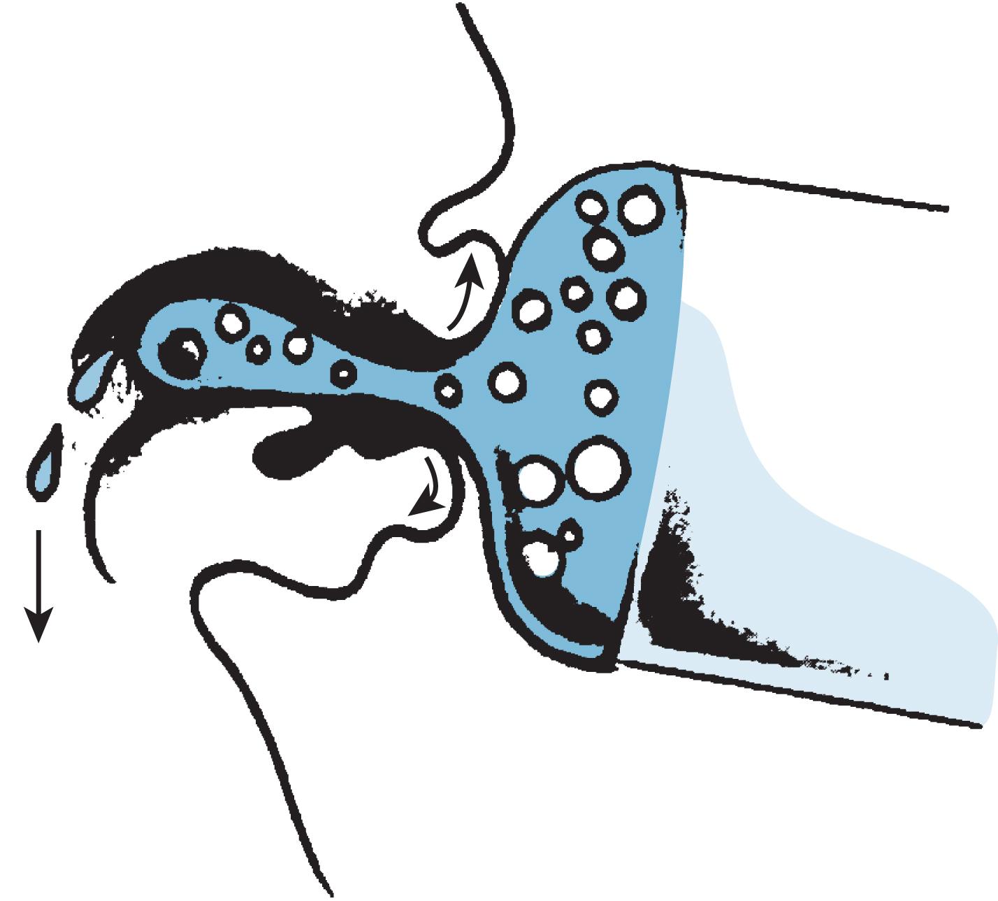 Fig. 3.11, Infant sucking on rubber nipple, which fills the mouth and thus prevents tongue action and provides flow without tongue movement. Flow occurs even if the lips are not tight around the rubber hub.