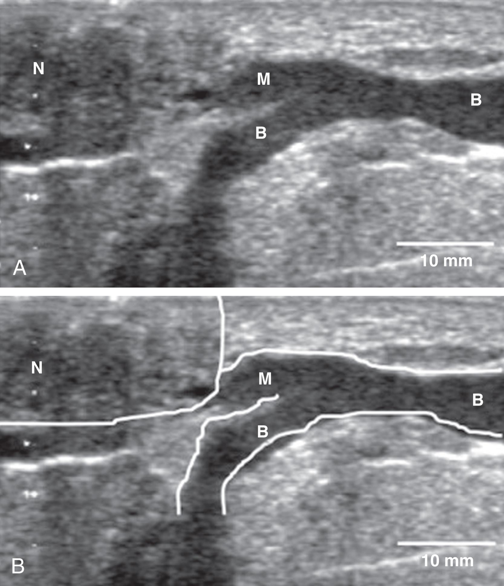 Fig. 3.8, (A and B) Ultrasound image of a main milk duct (Toshiba, Aplio). The nipple is the round hypoechoic (dark) structure in the left of the image (N) . The main duct (M) branches into two ducts (B) approximately 5 mm from the nipple. Note the small diameter of the ducts (approximately 3 mm).