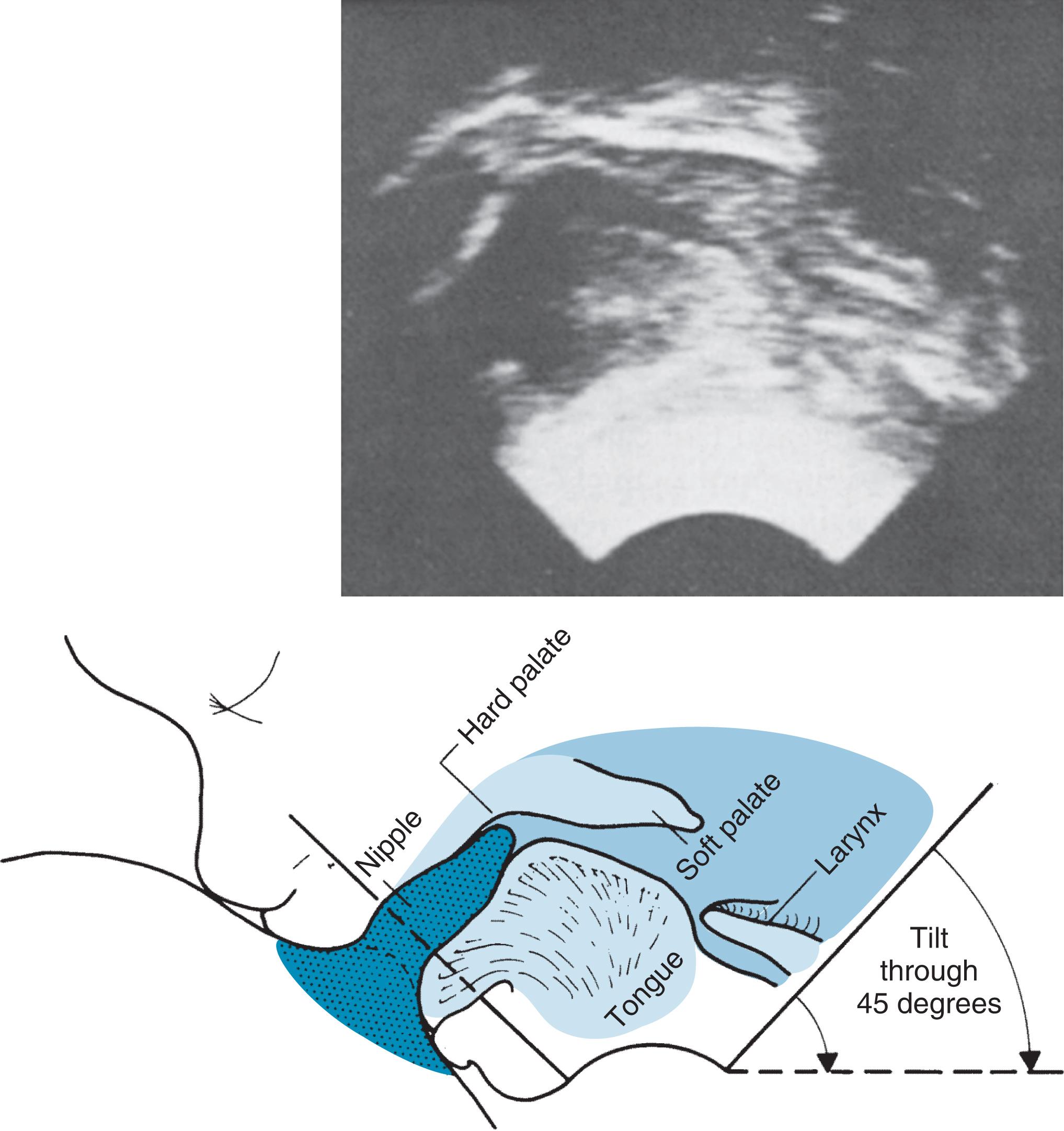 Fig. 3.10, Ultrasound of infant at breast. Still picture of ultrasound scan frame from video recording. The scanner head is at the bottom, with a sector view of 90 degrees. Below is an artist’s impression of the image showing key features. The image is seen best when tilted through 45 degrees so that the infant’s head is vertical. The picture corresponds to the point in the sucking cycle when the maximum point of compression of the nipple by the tongue has almost reached the tip of the nipple. Once the nipple has become fully expanded, a fresh cycle of compression will be initiated at the base of the nipple and will then move back.