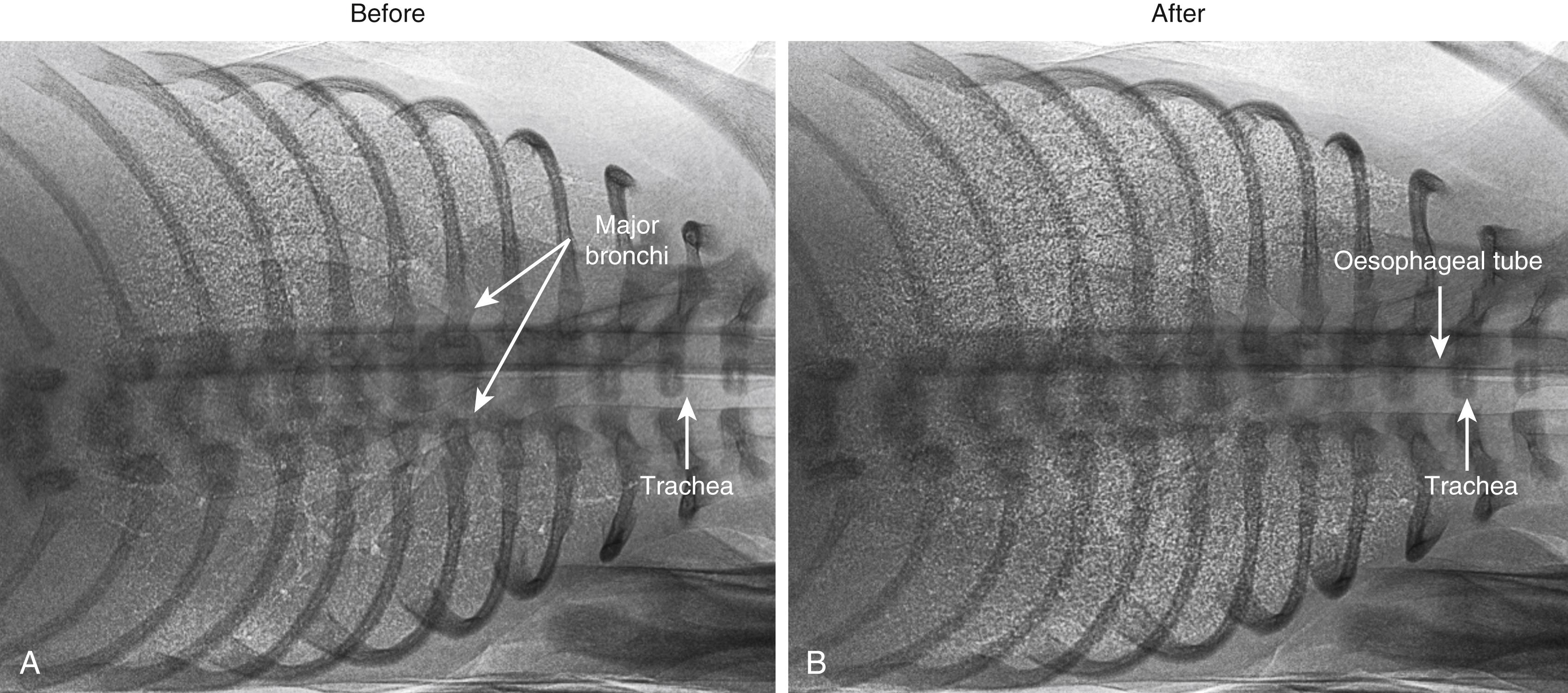 Fig. 150.2, Phase contrast x-ray images of a near-term (30 days) newborn rabbit acquired at rest immediately before (A) and after (B; approximately 600 ms later) a single breath during lung aeration. The trachea and major bronchi are clearly visible in both images, and the degree of lung aeration in the distal airways is evident by the degree of “speckle” in the image (refer also to Fig. 150.3). Note that aeration in the nondependent lung is greater than in the dependent lung in the image acquired before the breath (A) and that the chest wall has expanded after the breath compared with before the breath. The dark tubular structure in both images is an esophageal tube used to measure reductions in intrathoracic pressure and assess breathing activity.