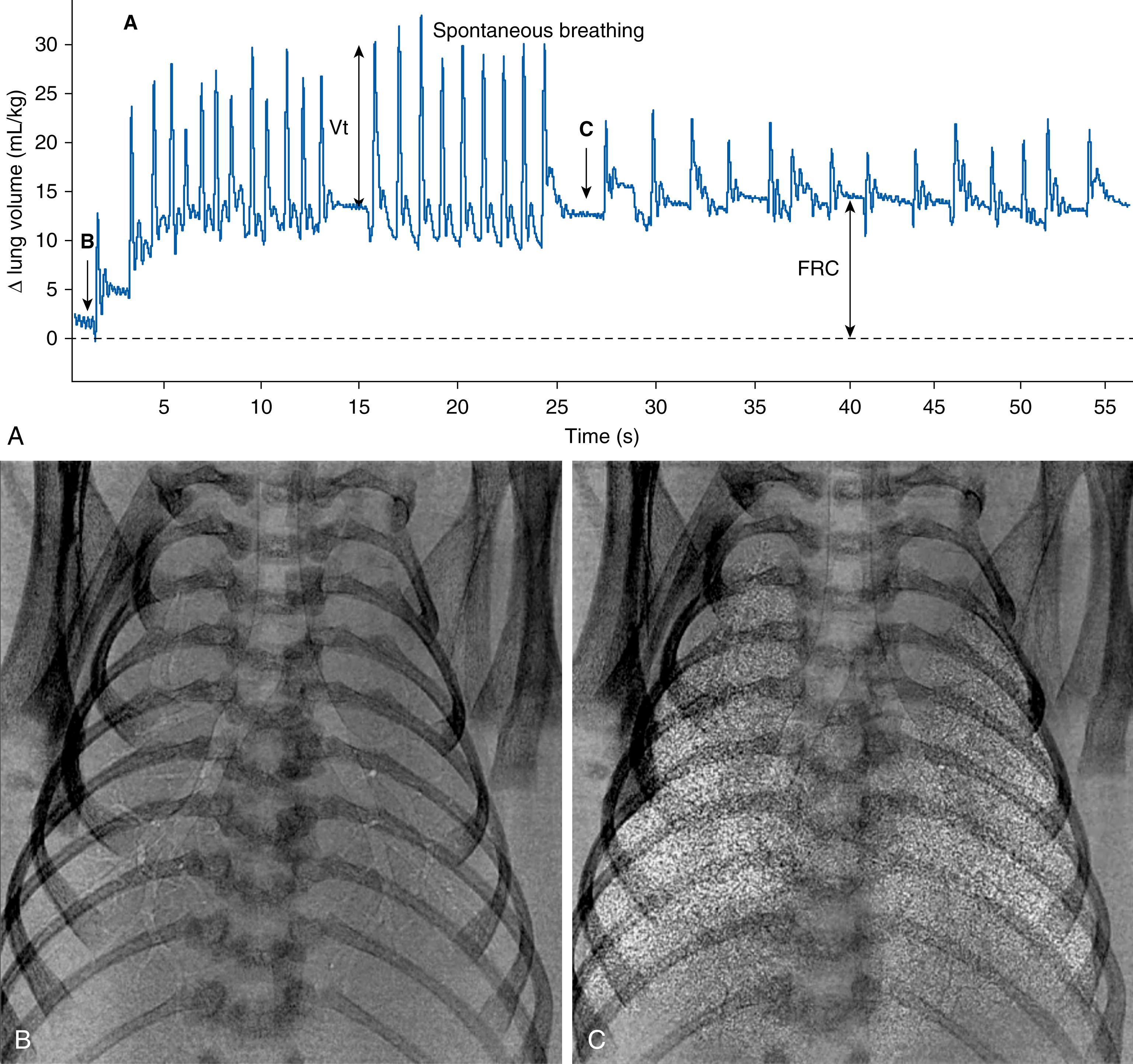 Fig. 150.3, (A) Lung gas volumes measured using a plethysmograph in a spontaneously breathing near term (31 days) newborn rabbit. Simultaneous phase contrast x-ray images were acquired near the beginning of lung aeration (B) and approximately 40 seconds later after the recruitment of a functional residual capacity (FRC) of approximately 15 mL/kg (C). The times at which each image was acquired are indicated by arrows on the plethysmograph recording. Initially, the tidal volume (Vt) of the initial spontaneous breaths was large (approximately 15 mL/kg), but this gradually reduced as the lung aerated. 23