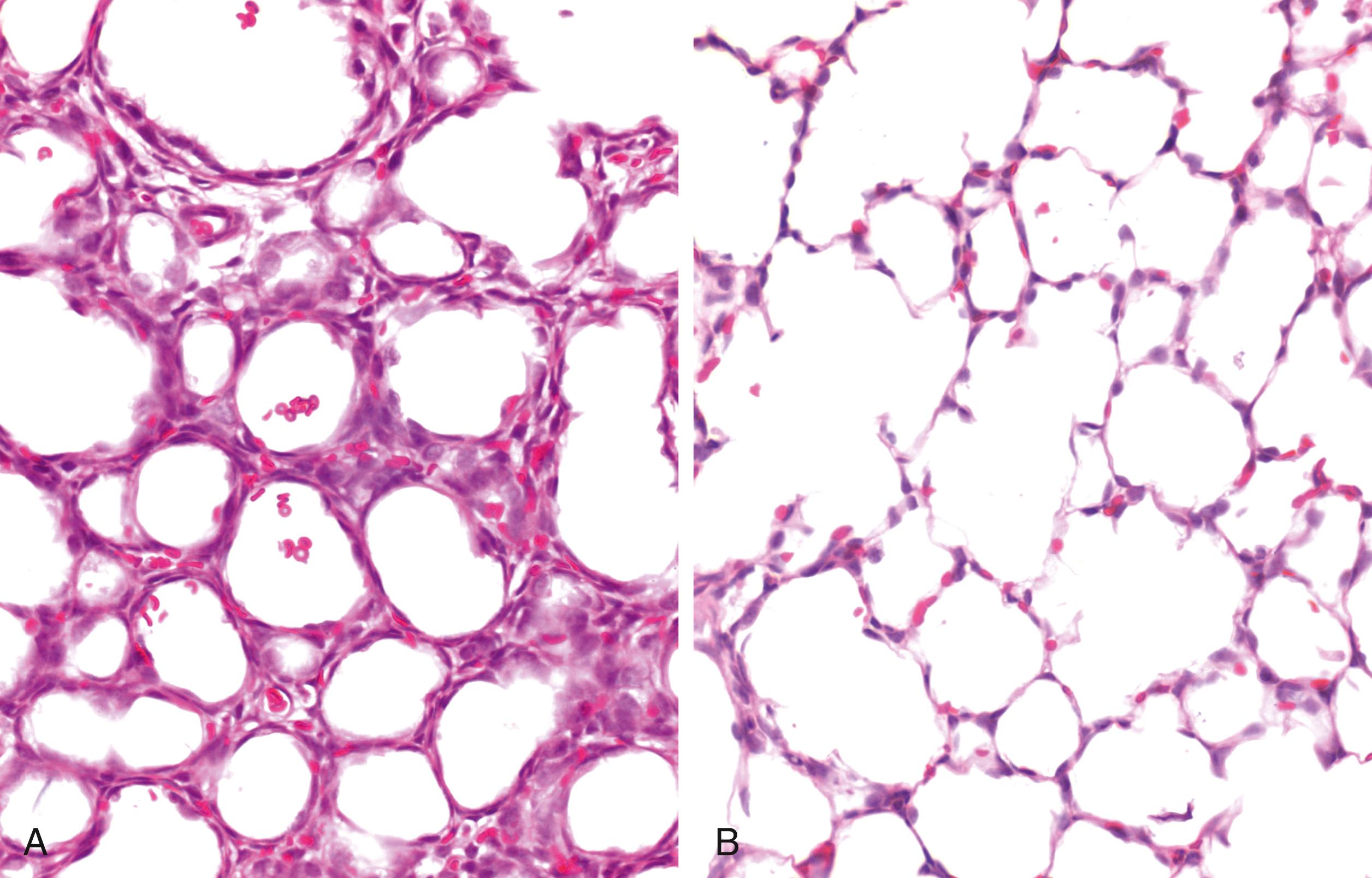 Fig. 150.6, Histologic sections of the lung collected from fetal sheep at approximately 60% (90 days; A) and near term (140 days; B) of gestation (term = approximately 147 days). Note that the immature lung (A) has simplified airway structures, with considerable amounts of lung tissue (magenta) separating the airways. Cell nuclei are stained a darker purple and red blood cells, most located in the blood vessels are stained a lighter red . Note that few blood vessels lie adjacent to the airway wall in the immature lung, whereas they lie in close apposition to the airspaces in the mature lung (B), thereby greatly reducing the air/blood gas barrier.