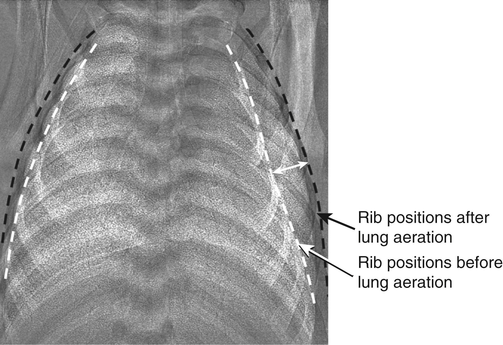 Fig. 150.7, Lung aeration increases chest wall expansion. Superimposition of two phase contrast x-ray images (contrast is inverted in one image) collected before (white ribs) and after (black ribs) lung aeration in a spontaneously breathing near-term newborn rabbit acquired between breaths (i.e., at functional residual capacity [FRC]). Following lung aeration, the chest wall significantly expands to accommodate both the air that forms the FRC after birth and the liquid that has moved from the airways into lung tissue but still remains in the chest. Chest wall expansion is also clearly evident in Fig. 150.2 .