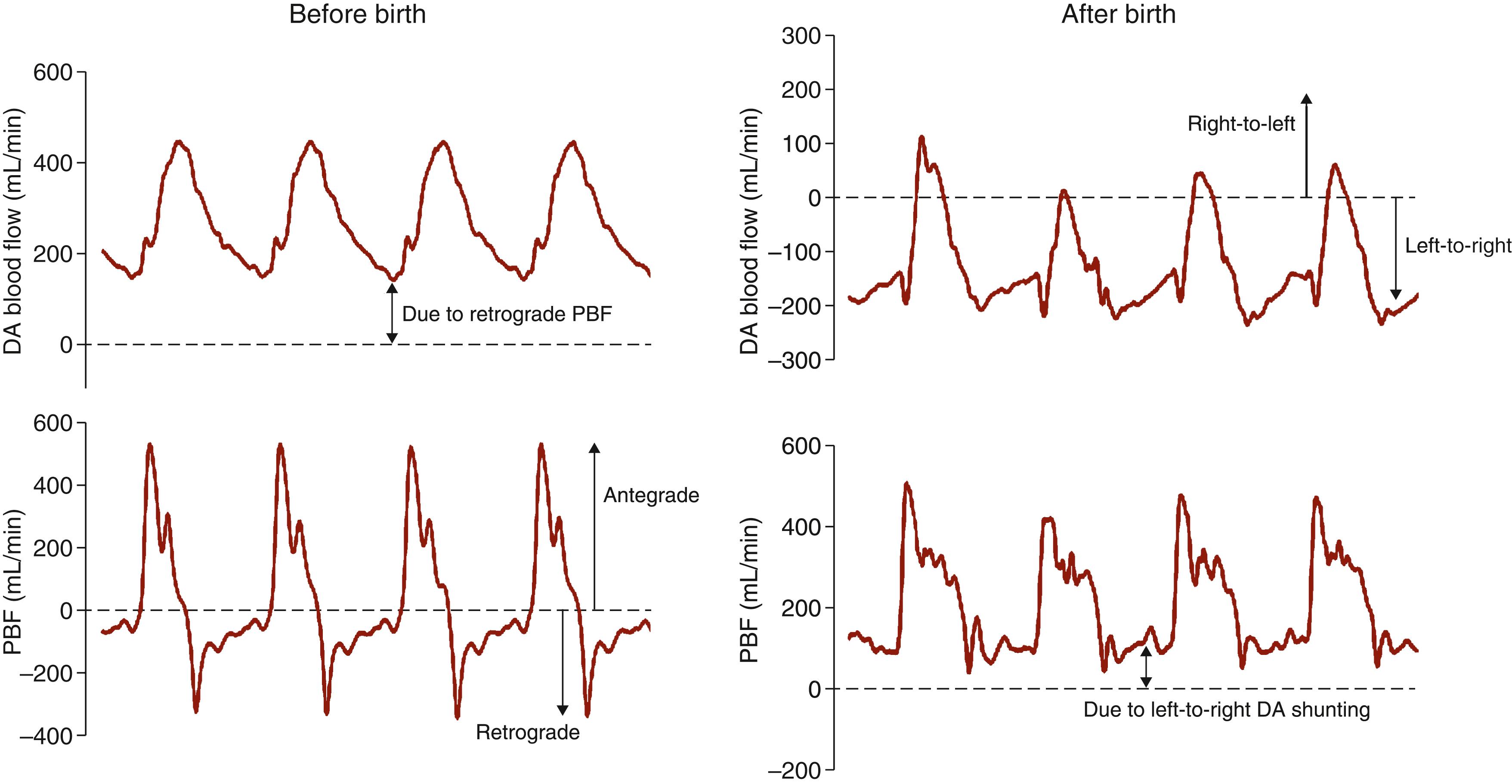 Fig. 150.9, Blood flow profiles in the left pulmonary artery (bottom panels) and in the ductus arteriosus ( DA ; top panels ) throughout four consecutive cardiac cycles before birth (left panels) and after birth, following lung aeration, in a newborn lamb. Before birth, retrograde (away from the lungs) pulmonary blood flow (PBF) is represented by negative PBF values and contributes to significant levels of right-to-left flow in the DA during diastole. As a result, continuous flow through the DA (right-to-left) occurs throughout the cardiac cycle. After birth and lung aeration, a decrease in pulmonary vascular resistance (PVR) causes a large increase in PBF, resulting in a loss of retrograde flow during diastole and the onset of left-to-right shunting through the DA. While DA flow is predominantly left-to-right, it is bidirectional. It is briefly right-to-left during early systole before reversing and becoming left-to-right in late systole and throughout diastole, when it significantly contributes to PBF. 38 This bidirectional pattern of DA flow is thought to result from the pressure wave emanating from the ventricle reaching the pulmonary artery end of the DA before the pressure wave arising from the left ventricle reaches the aortic end of the DA. As a result, the pressure gradient across the DA is initially right-to-left but then rapidly reverses to become left-to-right throughout most of the cardiac cycle.