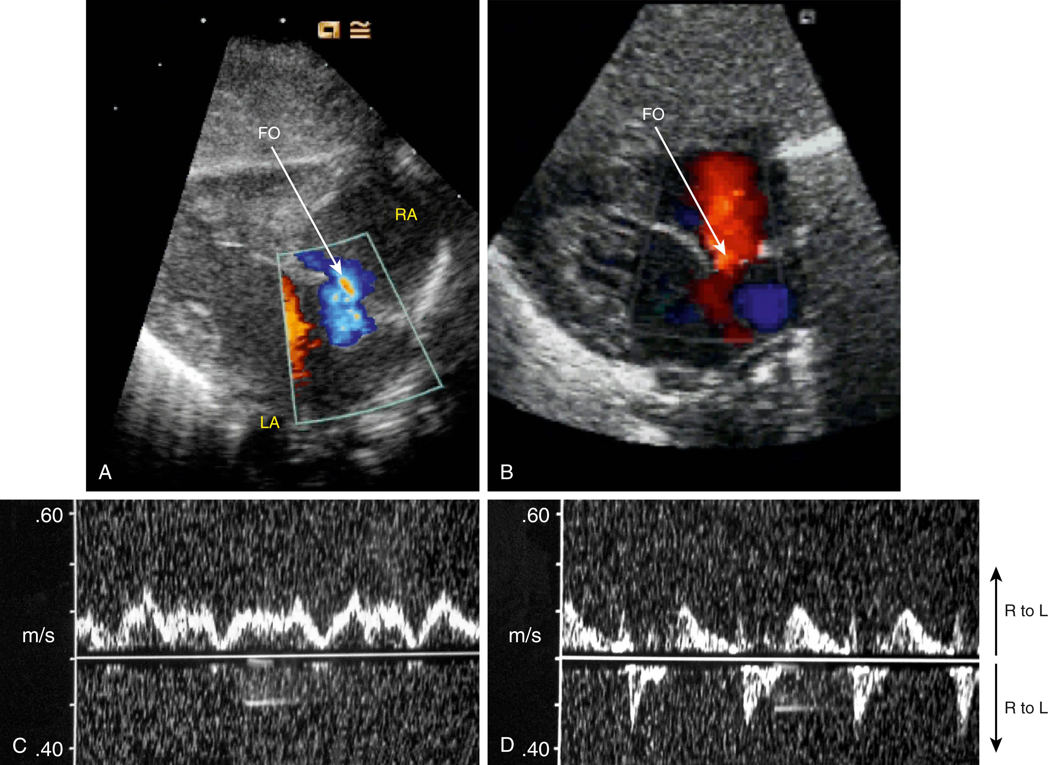 Fig. 150.10, Color Doppler images of flow patterns through the foramen ovale (FO) in human infants after birth (A and B) showing both right-to-left (A; R-to-L) and left-to-right (B; L-to-R) shunting. LA, Left atrium, RA, right atrium. Panels C and D show Doppler flow velocity waveforms through the FO in a newborn lamb immediately before (C) and after (D) umbilical cord clamping. Before cord clamping (C) the flow is almost entirely right-to-left, decreasing to zero during atrial contractions, whereas after clamping (D), the flow initially decreases to zero before becoming bidirectional.