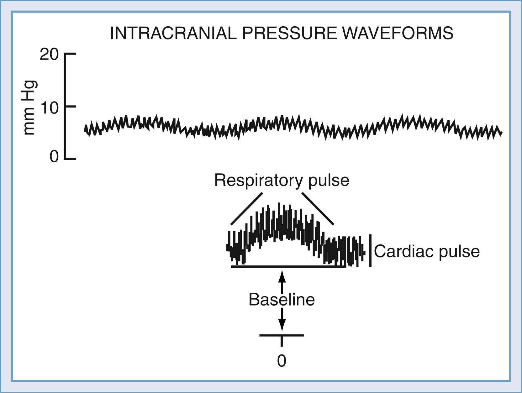 Figure 69.1, Normal intracranial pressure (ICP) waveform.