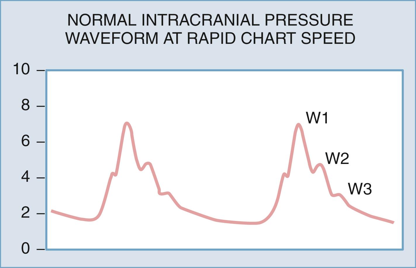Figure 69.2, Normal intracranial pressure waveform at rapid chart speed.