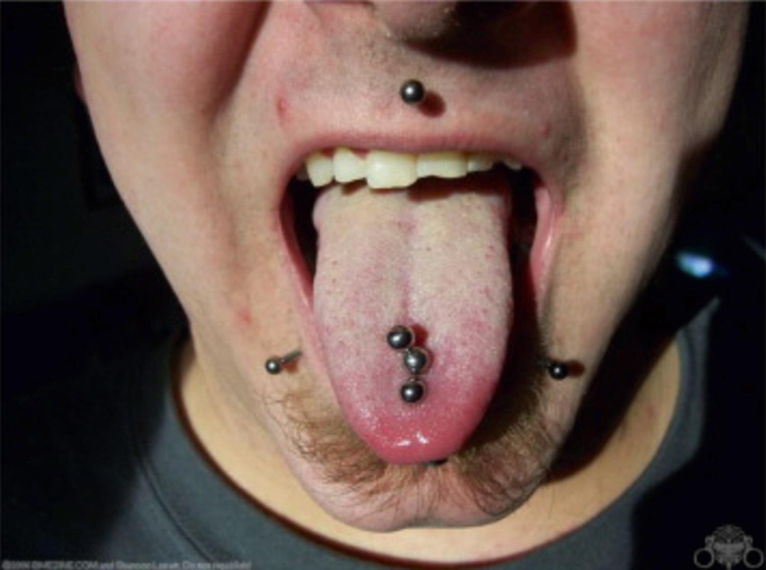 Fig. 150.1, Facial and tongue piercings. Notice chipped tooth.