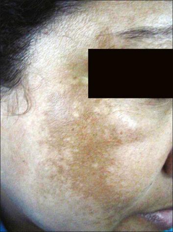 Figure 35-4, Melasma.