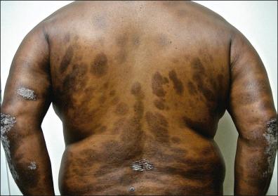 Figure 35-5, Postinflammatory hyperpigmentation.