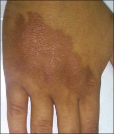 Figure 35-6, Postinflammatory hyperpigmentation: phototoxic reaction.