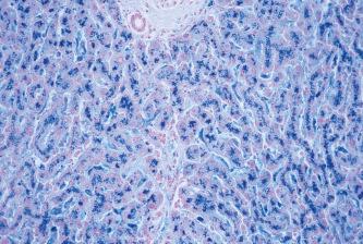 Fig. 14.1, A section of liver from a patient with hemochromatosis stained for ferric iron with Perls’ method. Ferric iron is stained blue.
