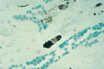 Fig. 14.3, A section of kidney from a patient with hemoglobinuria stained for hemoglobin with leuco patent blue V. Hemoglobin is stained blue.