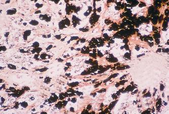 Fig. 14.6, A section of liver from a patient with malignant metastatic melanoma stained with Churukian’s method for melanin. Melanin is stained black.