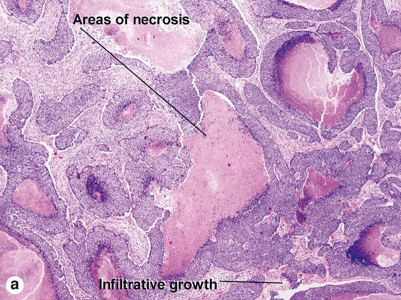 Fig. 4.2, Pilomatrical carcinoma