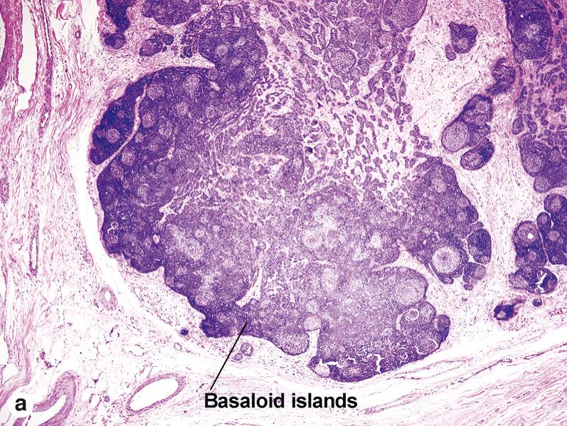 Fig. 4.3, Trichoblastoma