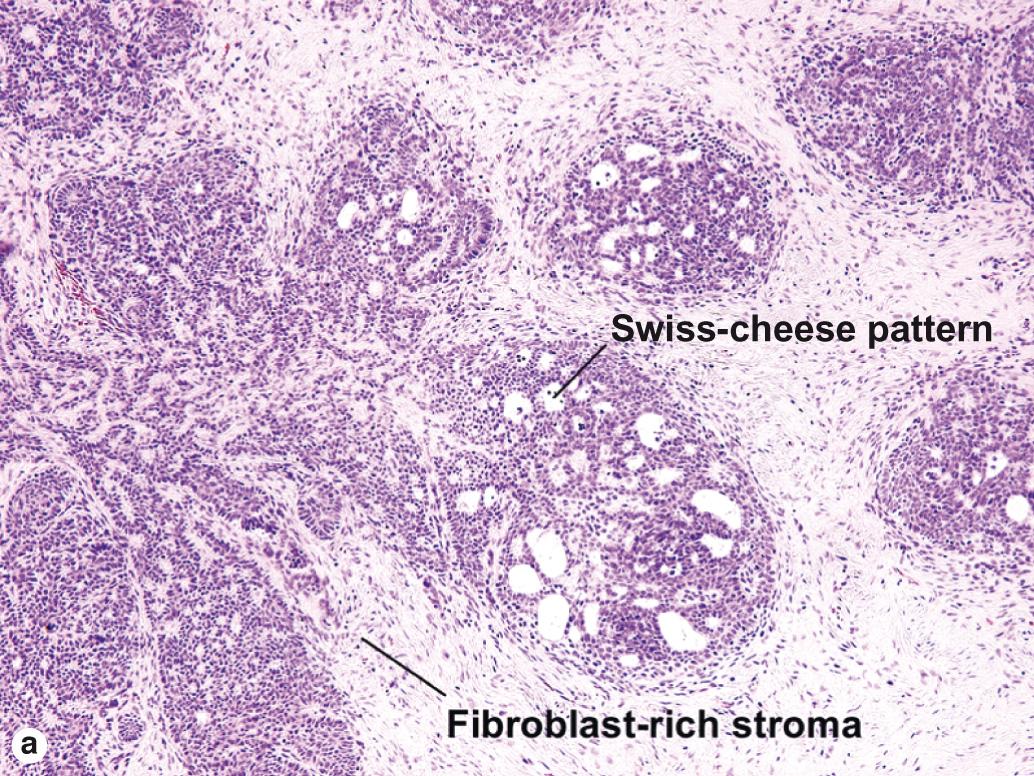 Fig. 4.4, Trichoepithelioma