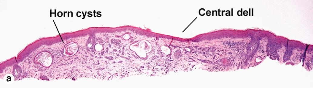 Fig. 4.6, Desmoplastic trichoepithelioma