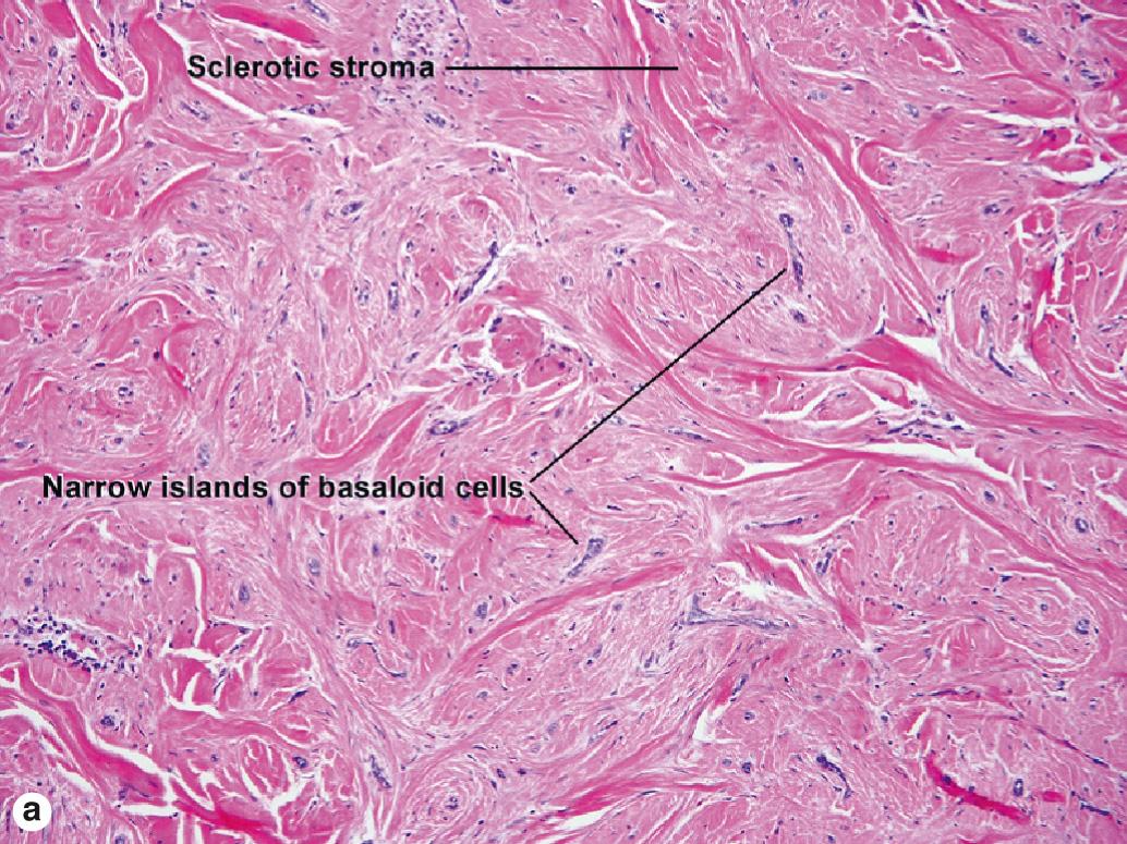Fig. 4.7, Morpheaform basal cell carcinoma for comparison