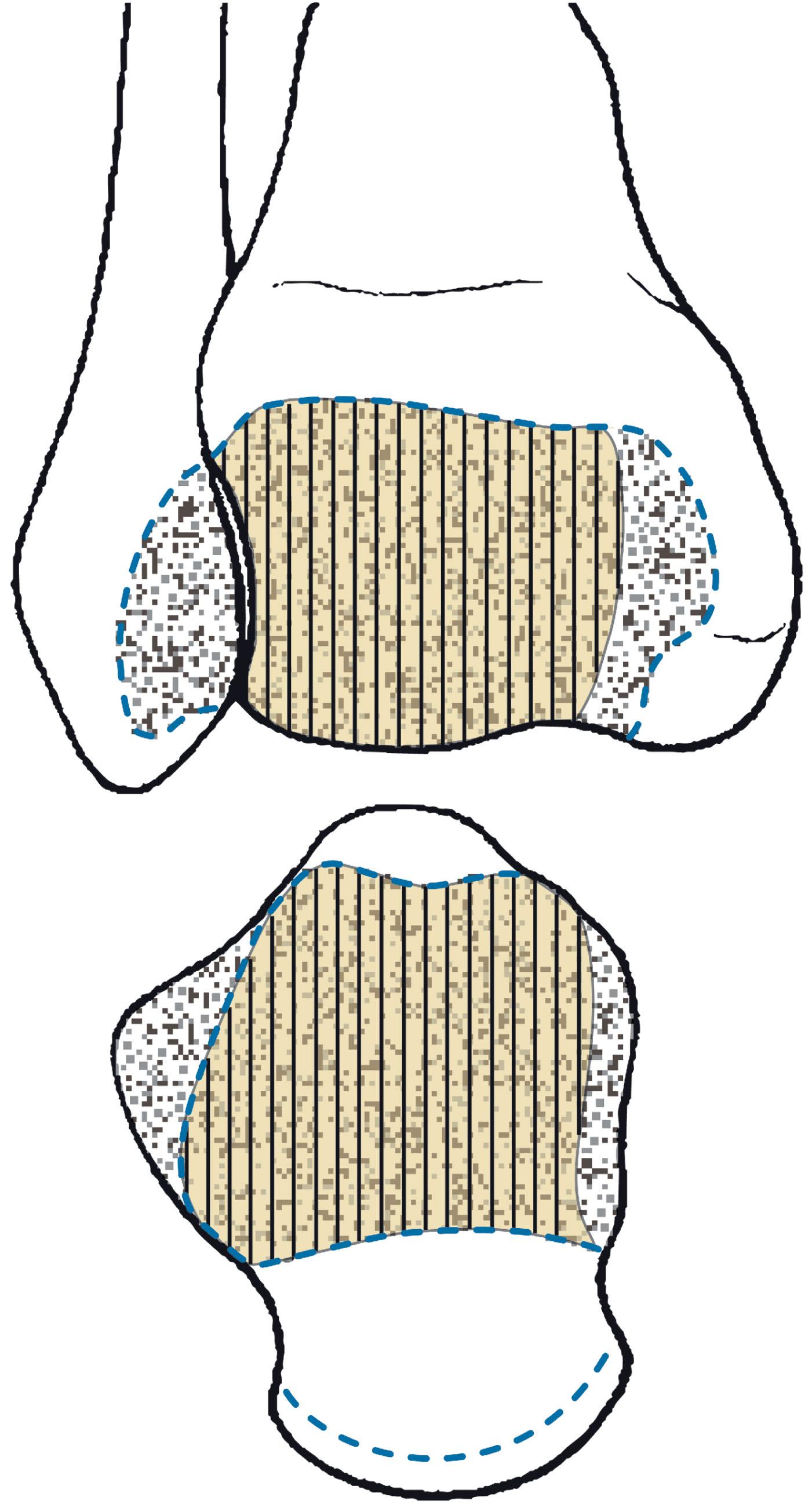 Fig. 43-1, The articulating surface of the distal tibia. Note the lesser articulations with the malleoli.