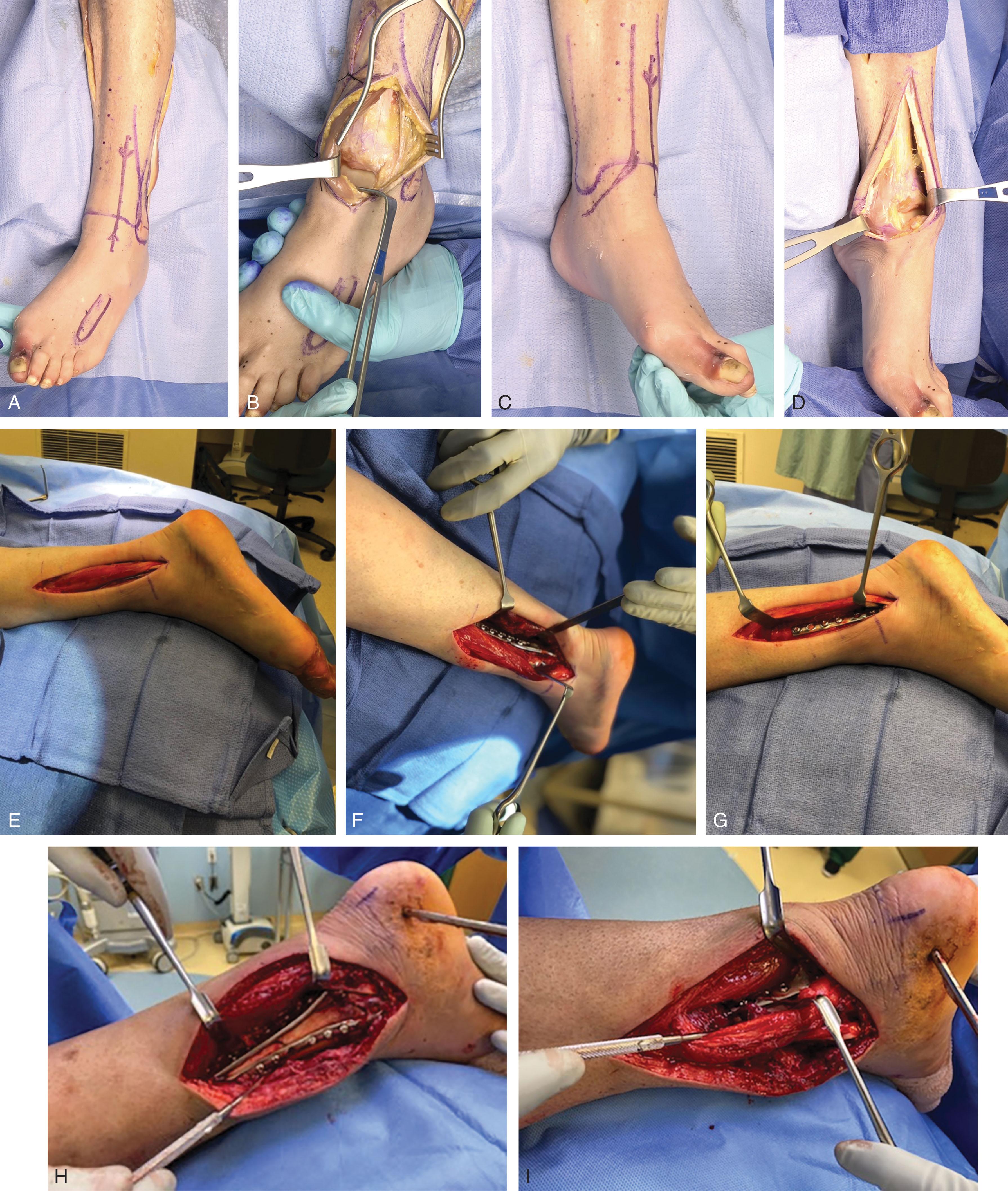 Fig. 43-11, Anterolateral ( A and B ), anteromedial ( C and D ), posterolateral ( E – G ), and posteromedial ( H and I ) approaches.