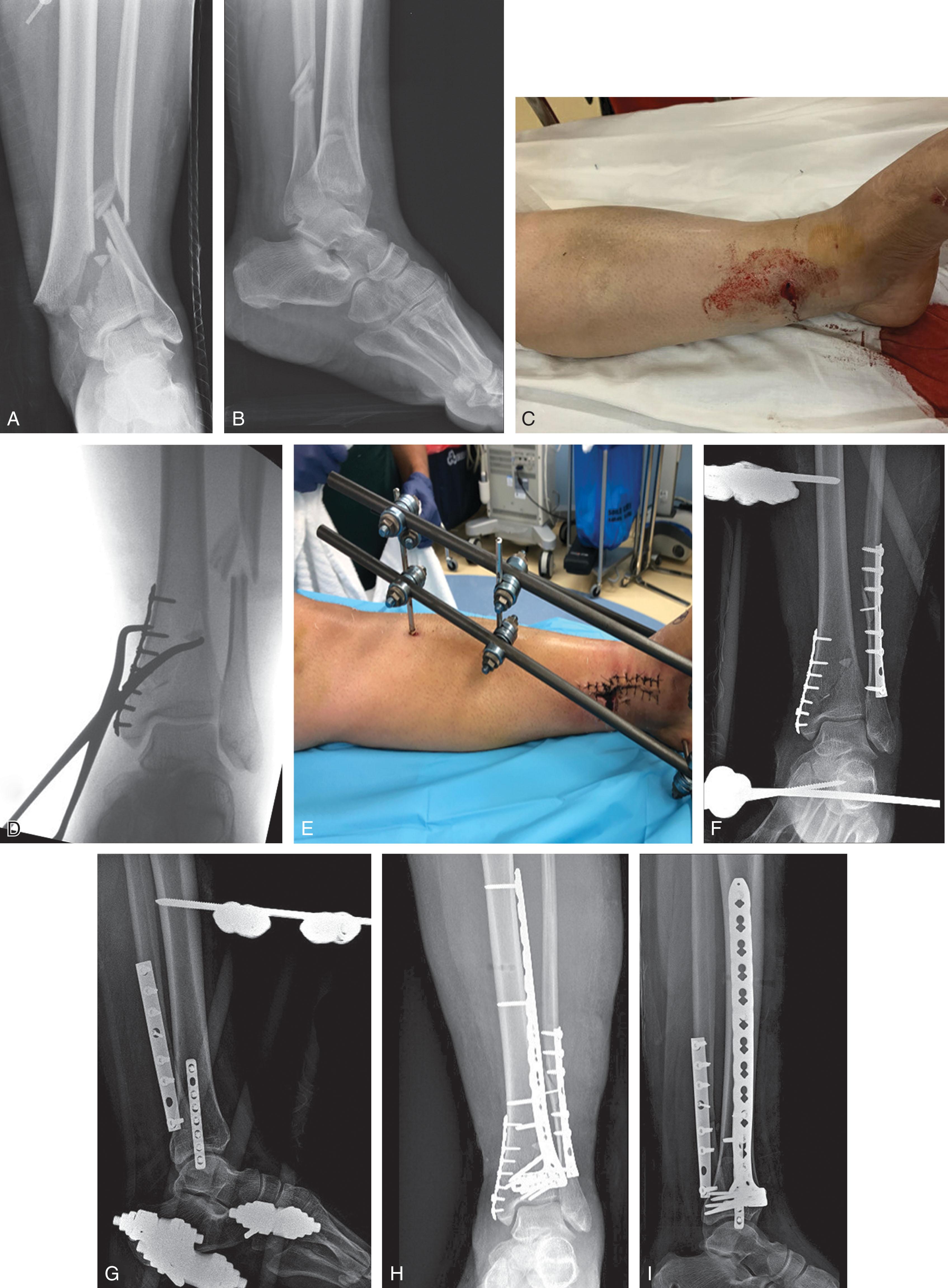 Fig. 43-12, A and B , Radiographs of an open C-type pilon fracture. C , Note the incisional necrosis at the traumatic wound that may not heal over a larger plate but will tolerate a smaller implant. D and E , After irrigation and debridement, the fracture was treated in stage 1 with fibular plating using a low-profile mini-fragment plate applied through the traumatic wound and spanning externa fixation. F and G , Stage 2 three weeks later involved percutaneous anterolateral plate placement with removal of the external fixator. H and I , Final radiographs.