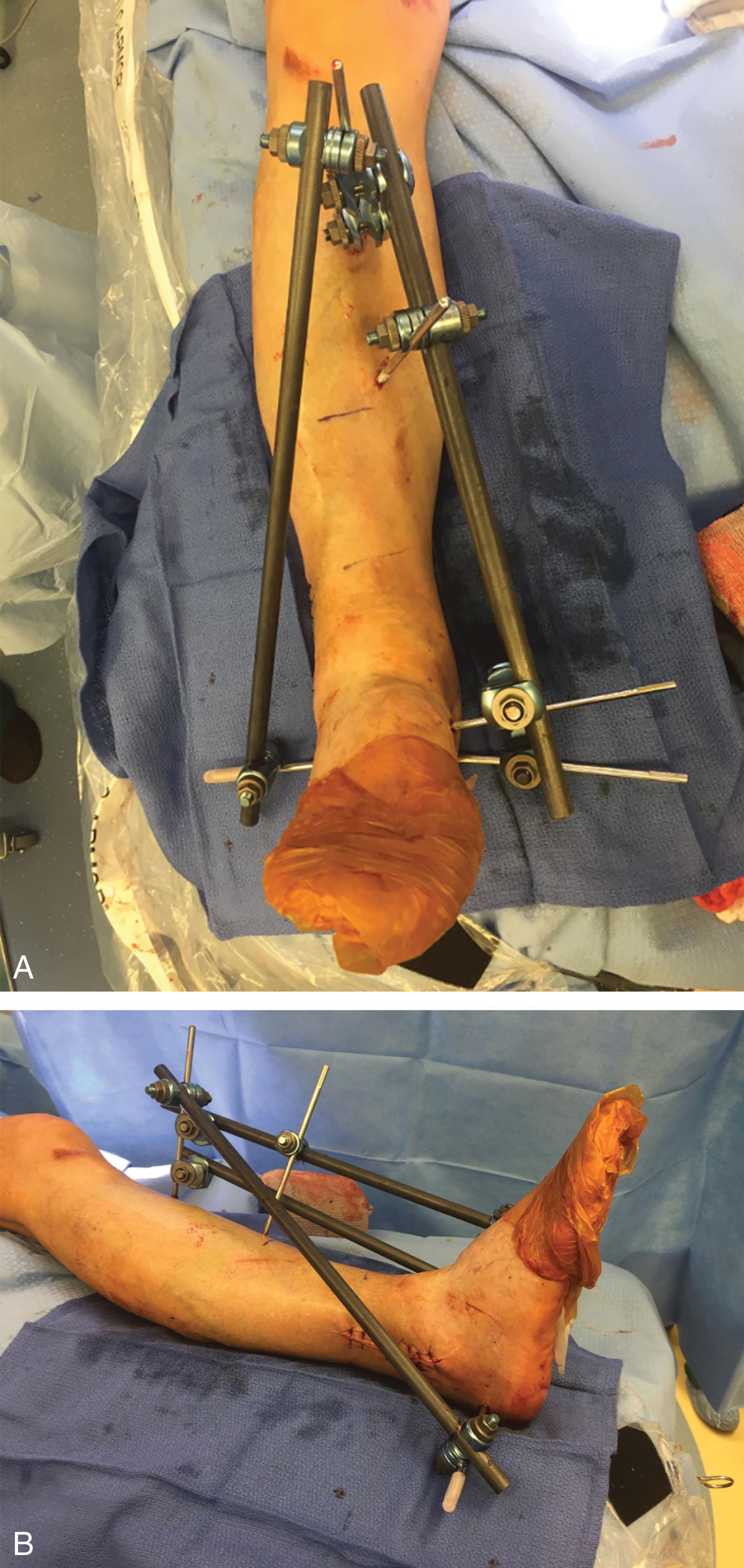 Fig. 43-13, Conventional delta frame using two tibial pins, one calcaneal transfixion pin and a cuneiform pin connected using single pin-to-bar clamps. A , Front view. B , Side view.