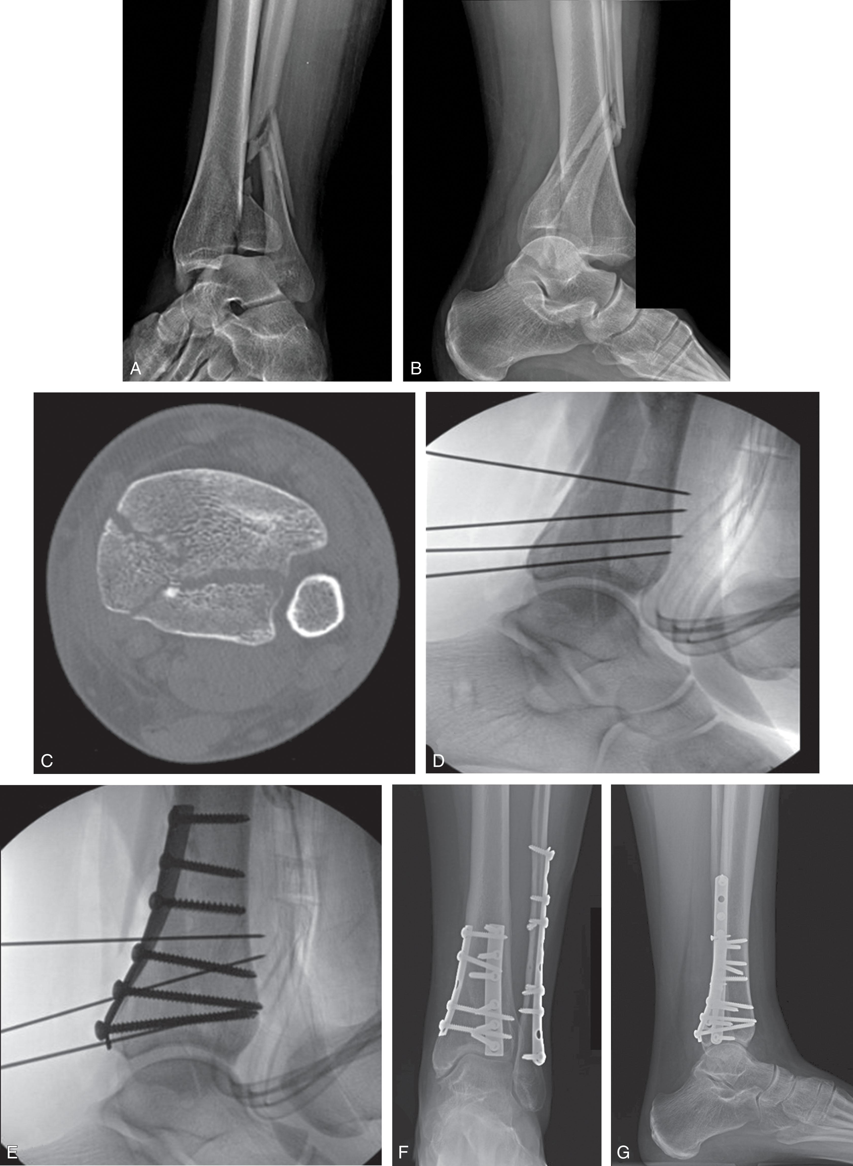 Fig. 43-14, A and B , Radiographs and C , CT scan of a posterior B-type pilon fracture with both posteromedial and posterolateral fragments. D and E , This is treated in prone position with combined posteromedial and posterolateral approaches. Two one-third tubular plates are placed over each fracture apex to act as a buttress against posterior displacement. F and G , Final radiographs after internal fixation.