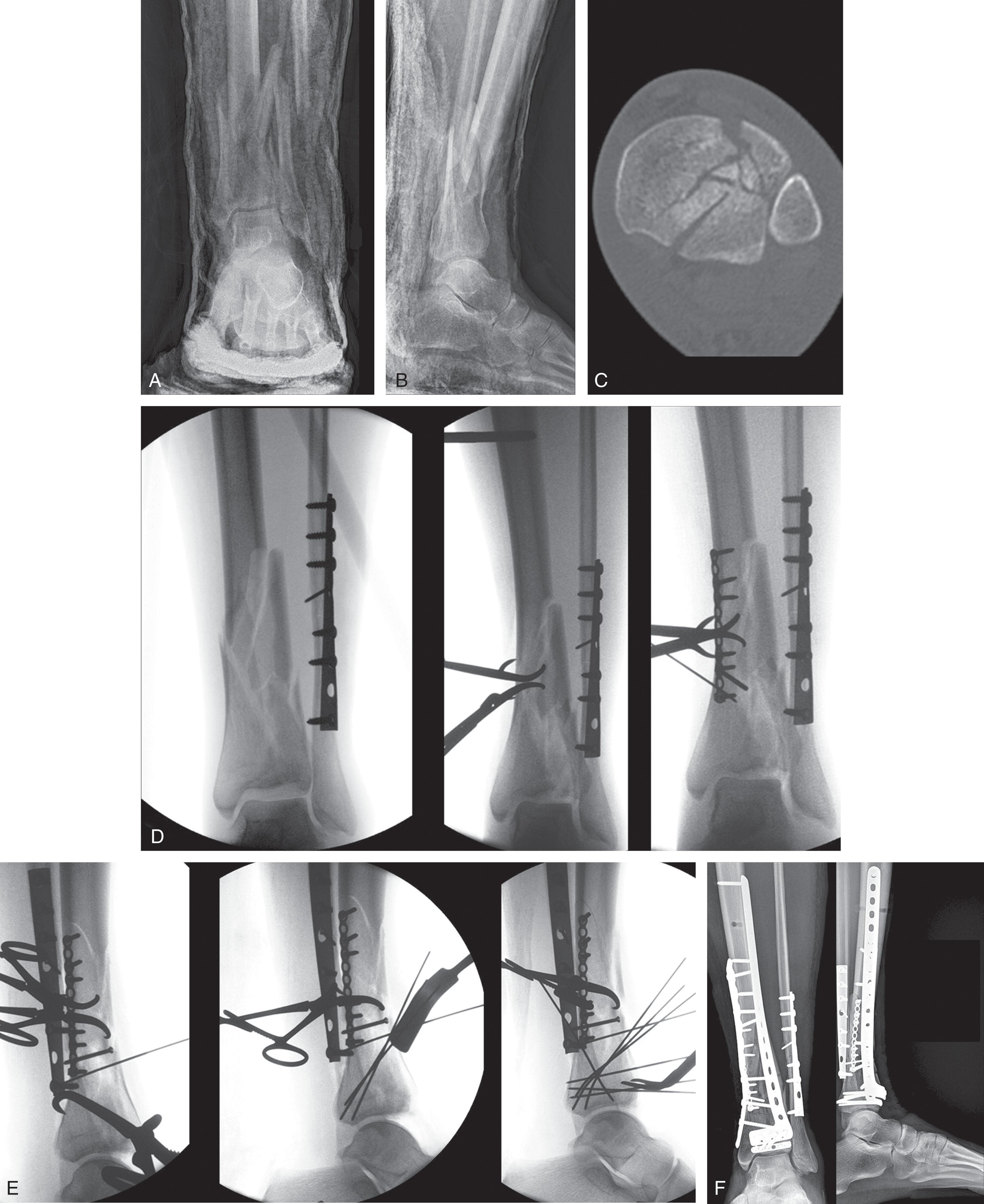 Fig. 43-15, A and B , Radiographs and C , a CT scan of a C-type pilon fracture treated with an anterolateral approach. CT scan shows a lateral exit of the anterior fracture with central impaction. D and E , Intraoperative fluoroscopy views showing fracture reduction using an anterolateral approach. In this case a posteromedial approach was added to realign the articular block to the shaft. Because the patient was supine, the posterior malleolus was reduced indirectly using a reduction clamp passed through the distal extent of the posteromedial incision. F , Definitive fixation was achieved with both anterolateral and medial plating.
