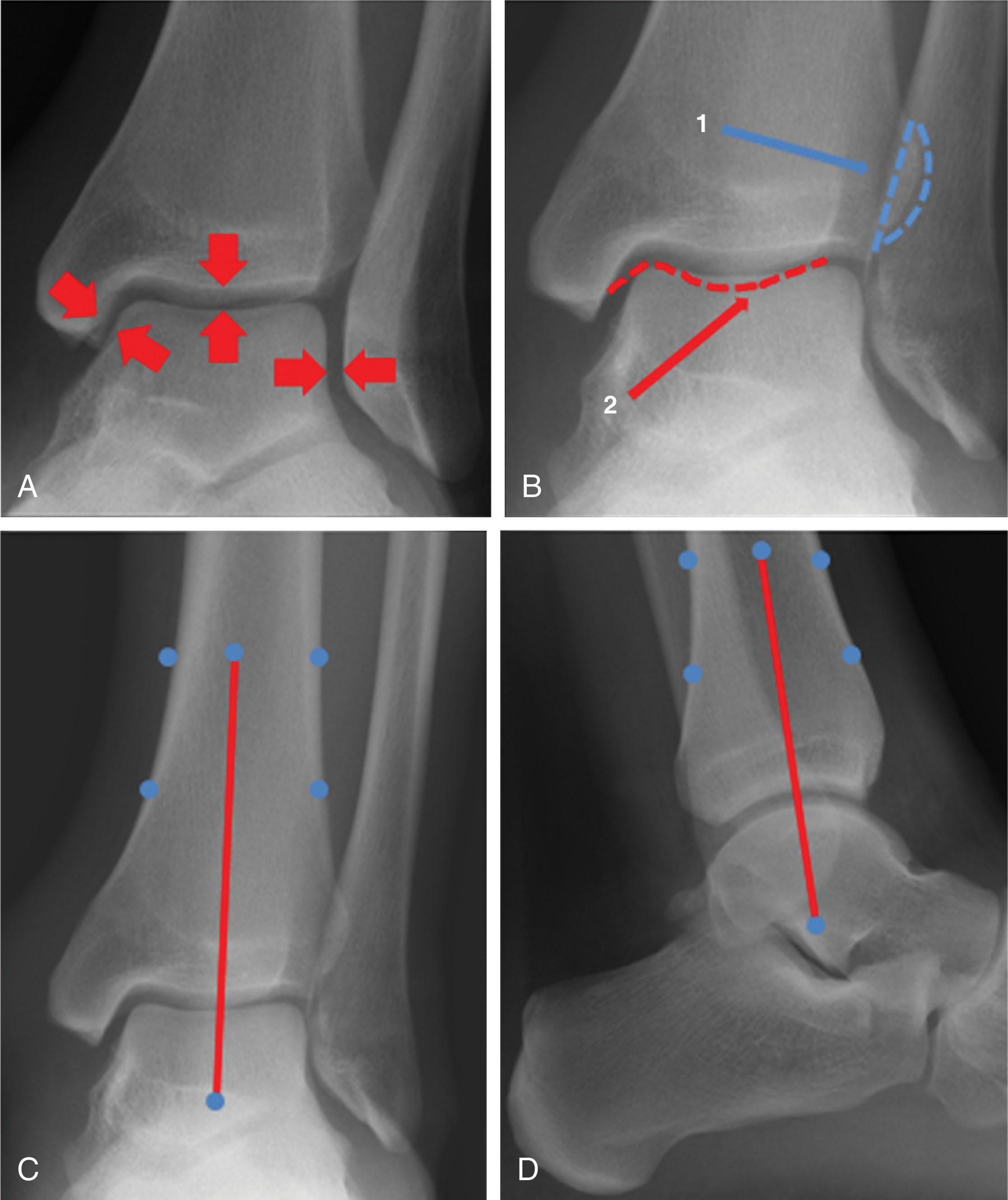 Fig. 43-2, A , The articular surface should be equidistant throughout the joint (arrows) . B , The incisura, where the fibula articulates with the distal tibia (1) and the posterior malleolus (2) . C and D , The central axis of the leg (red line) runs through the center of the plafond and the talus.