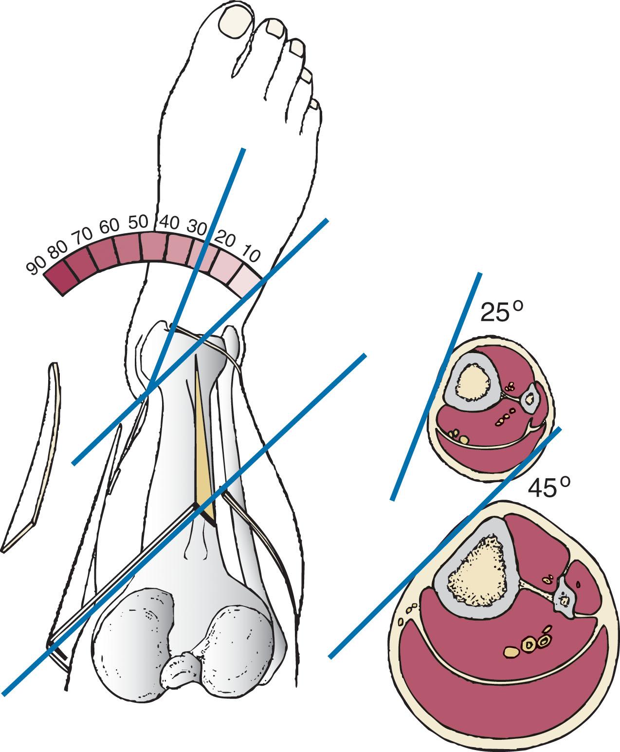 Fig. 43-4, Tibial torsion. At the distal end, the torsion is approximately 25 degrees. As one moves up the leg, the torsion becomes more extreme, approaching 45 degrees.